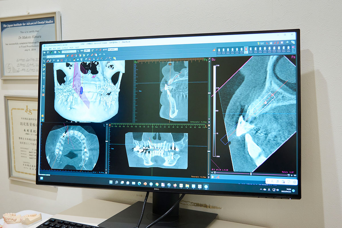 インプラント手術支援ソフト