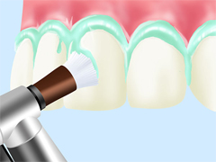 歯のクリーニング「PMTC」