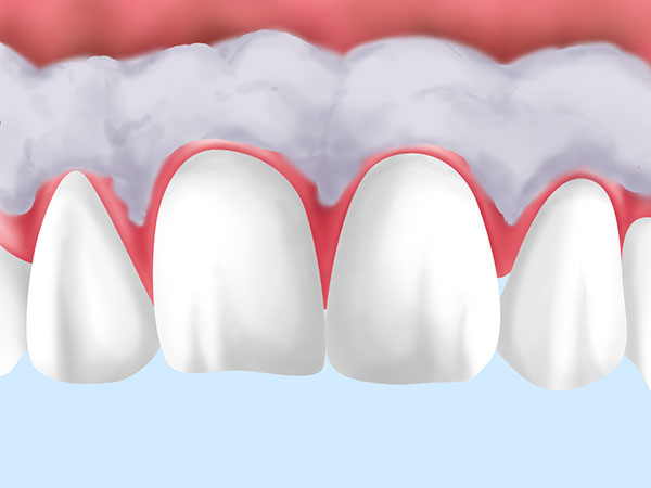 歯ぐきのクリーニング