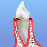 軽度歯周病（歯肉炎・軽度歯周炎）