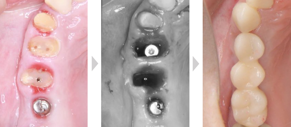 抜歯即時インプラント