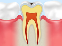 【CO】ごく初期のむし歯