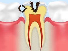 【C2】象牙質のむし歯