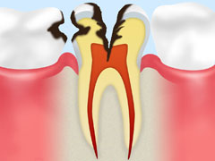 【C3】神経に達したむし歯
