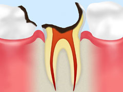 【C4】歯根に達したむし歯