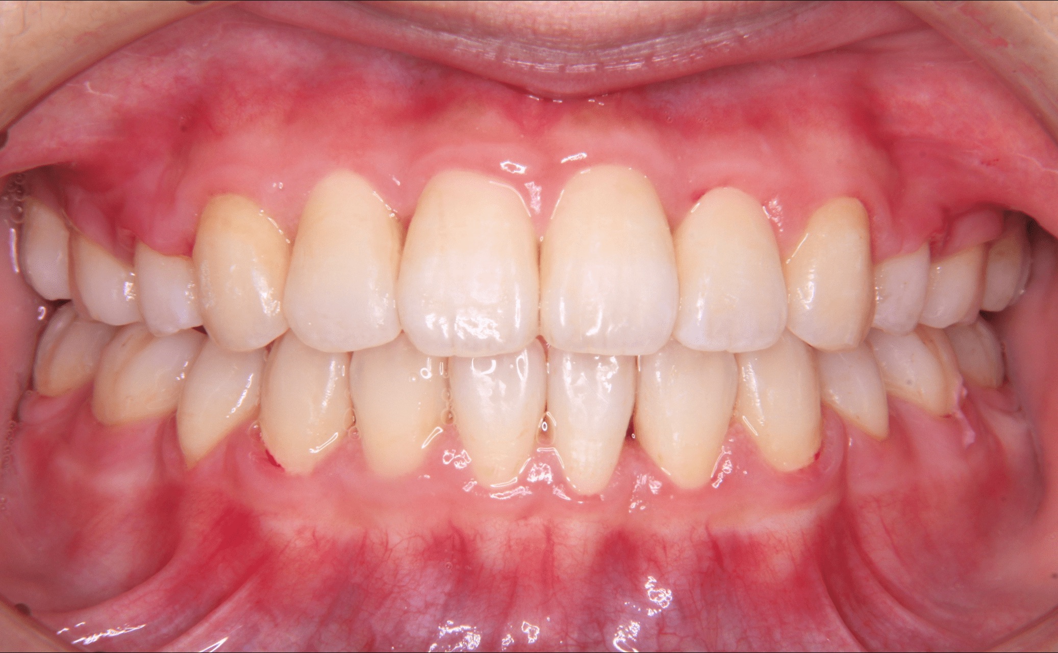 開咬症・叢生の矯正歯科治療 （歯のでこぼこ、前歯が噛んでいない）