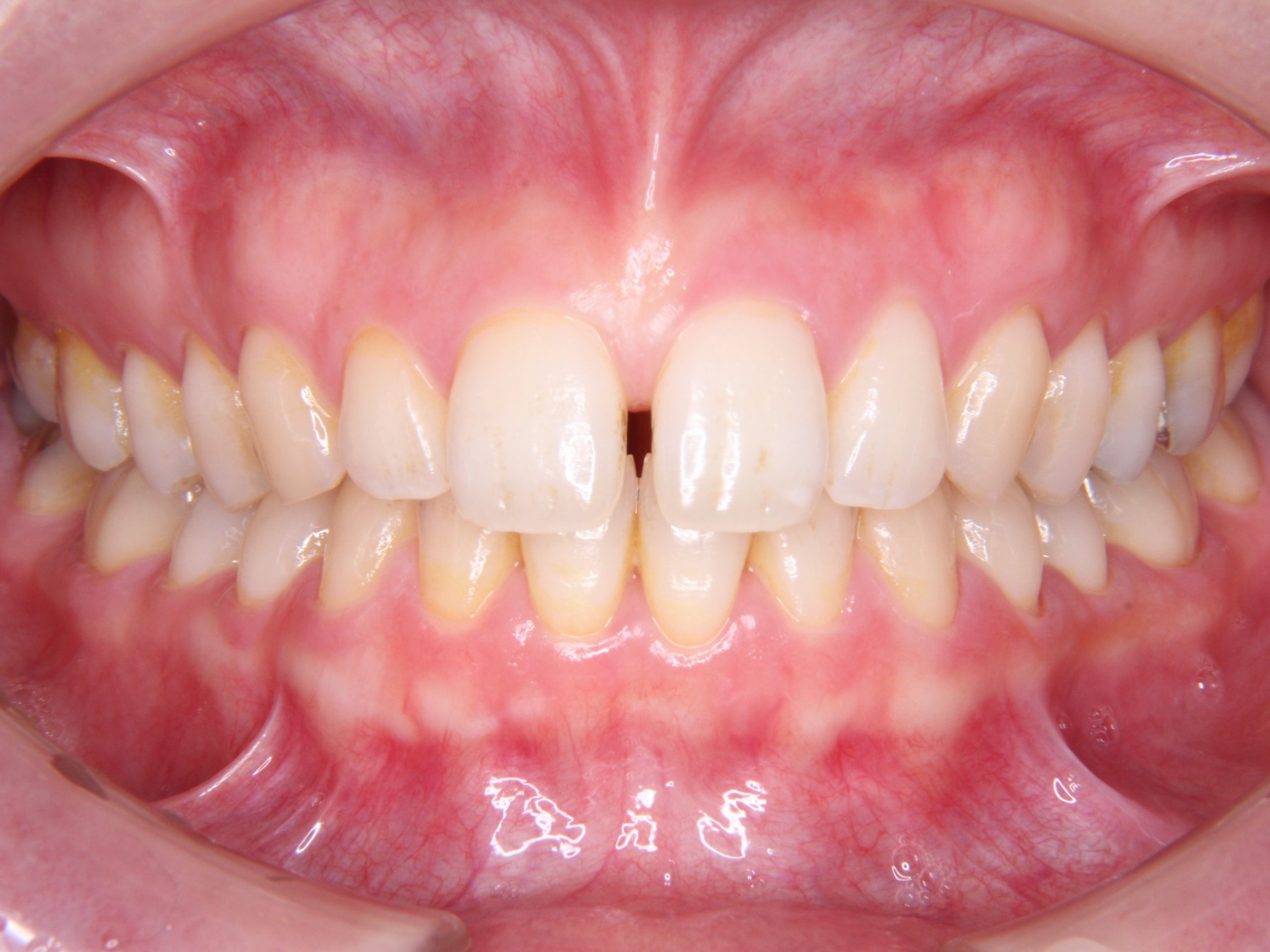 すきっ歯　見えない矯正治療（舌側矯正）
