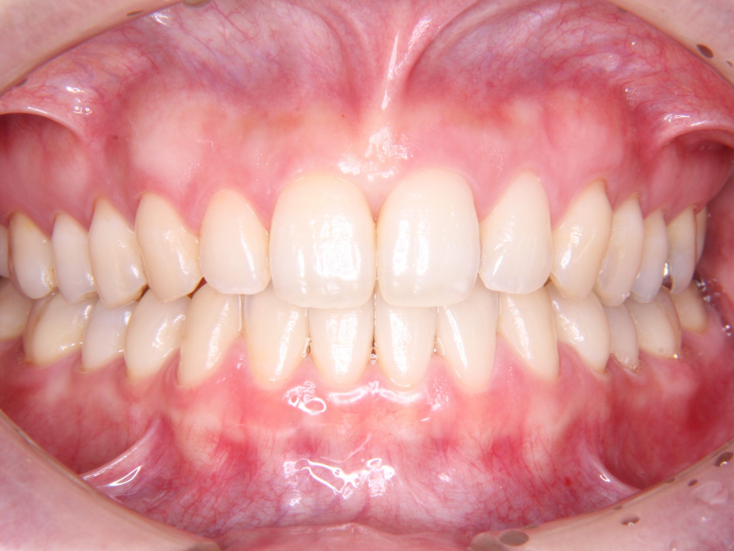 すきっ歯　見えない矯正治療（舌側矯正）
