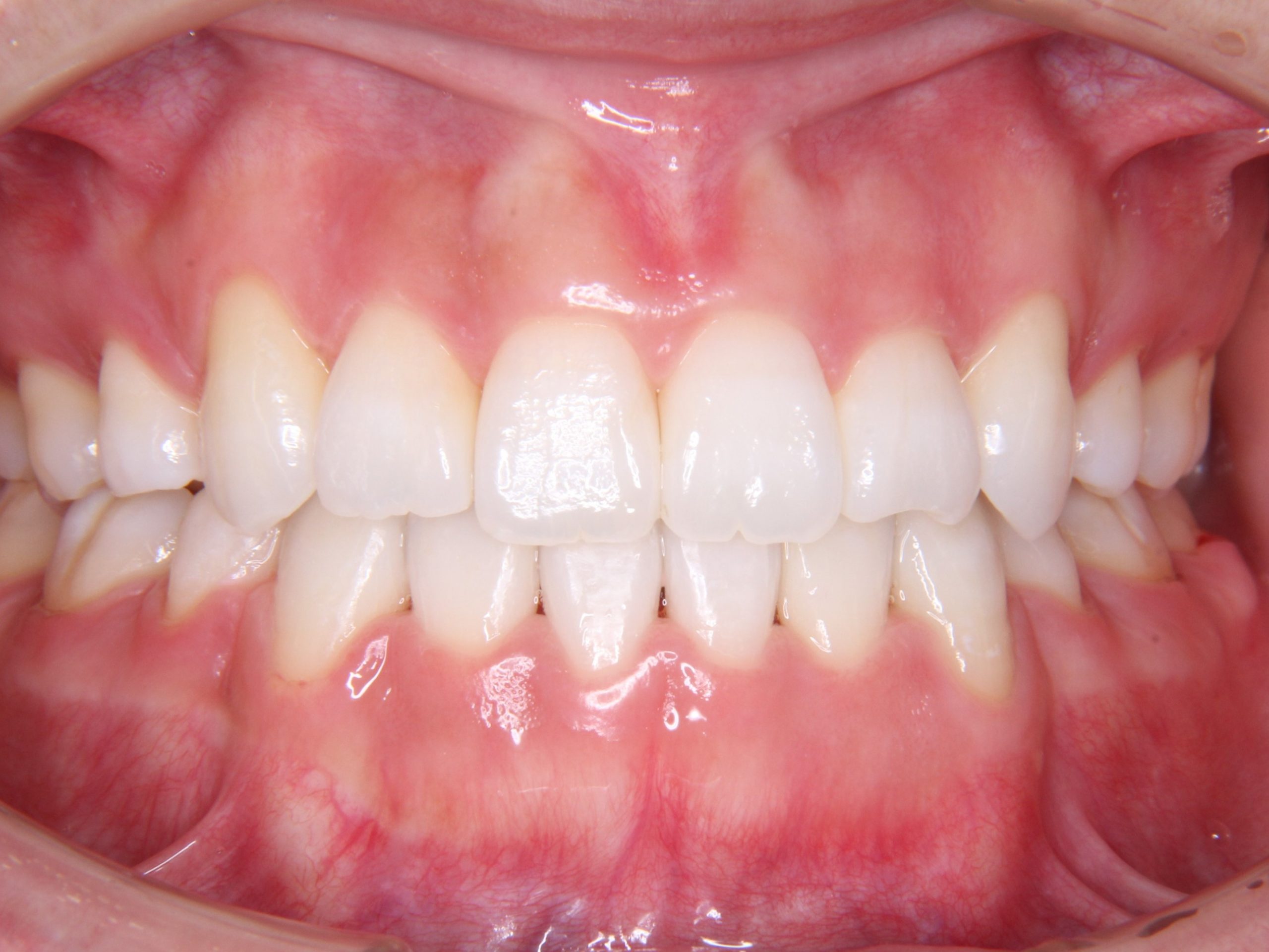 舌側矯正歯科治療 （ハーフリンガル：上顎舌側矯正、下顎表側矯正）