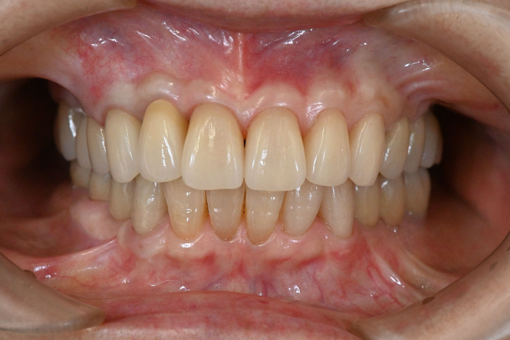 前歯部インプラントを含む全顎治療②