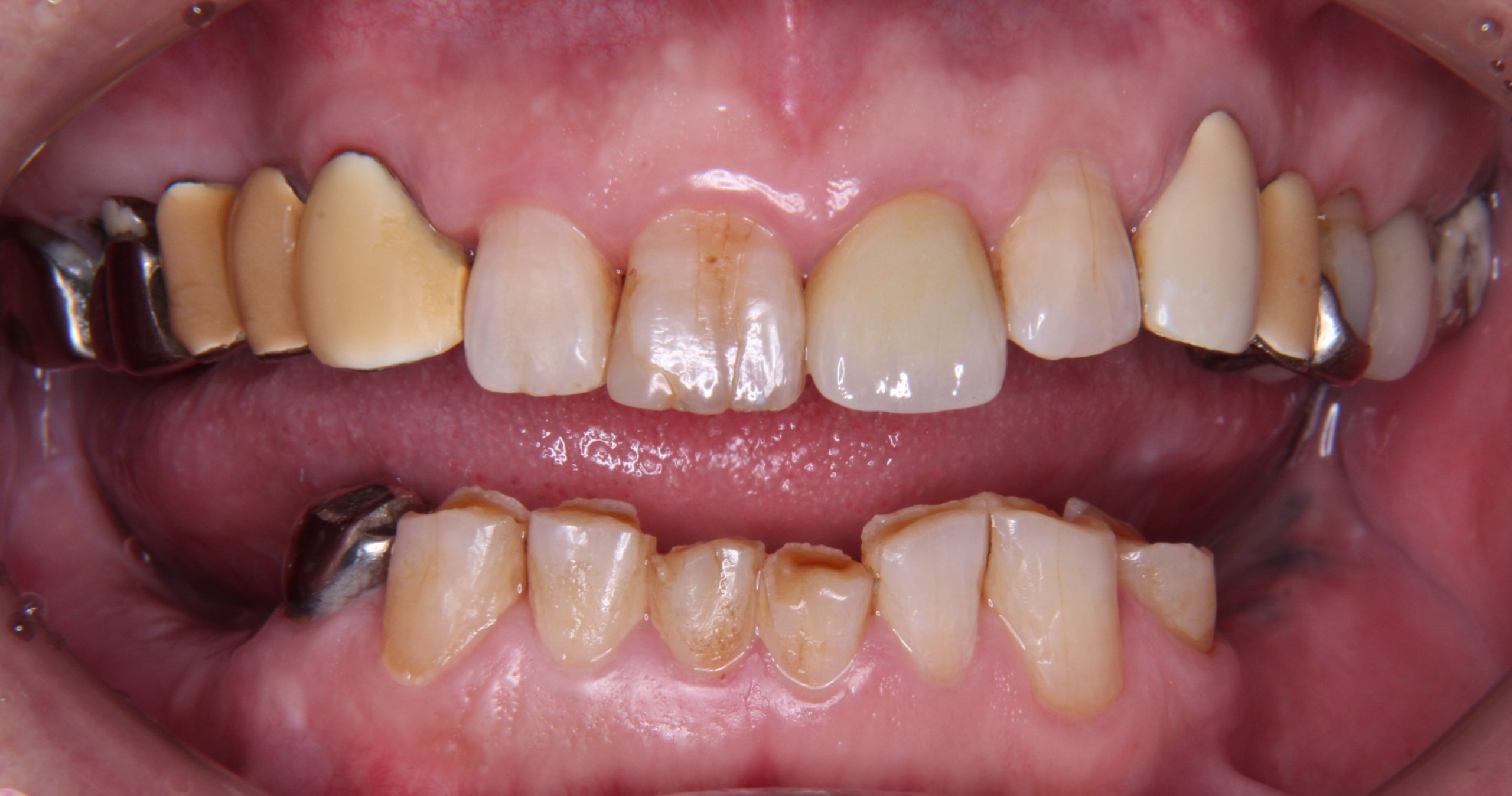 すり減ってしまった歯（短い歯）を綺麗に回復するとともに、インプラントで入れ歯の悩み解消