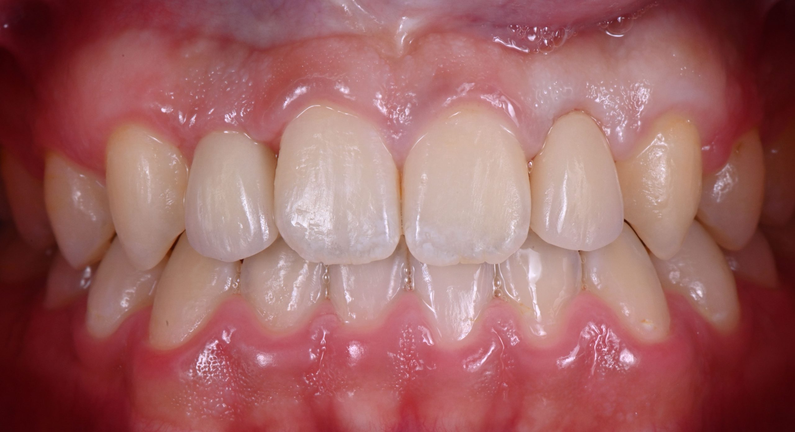 生まれつき前歯の歯数が少ない　笑顔になると歯茎が見える（ガミースマイル）