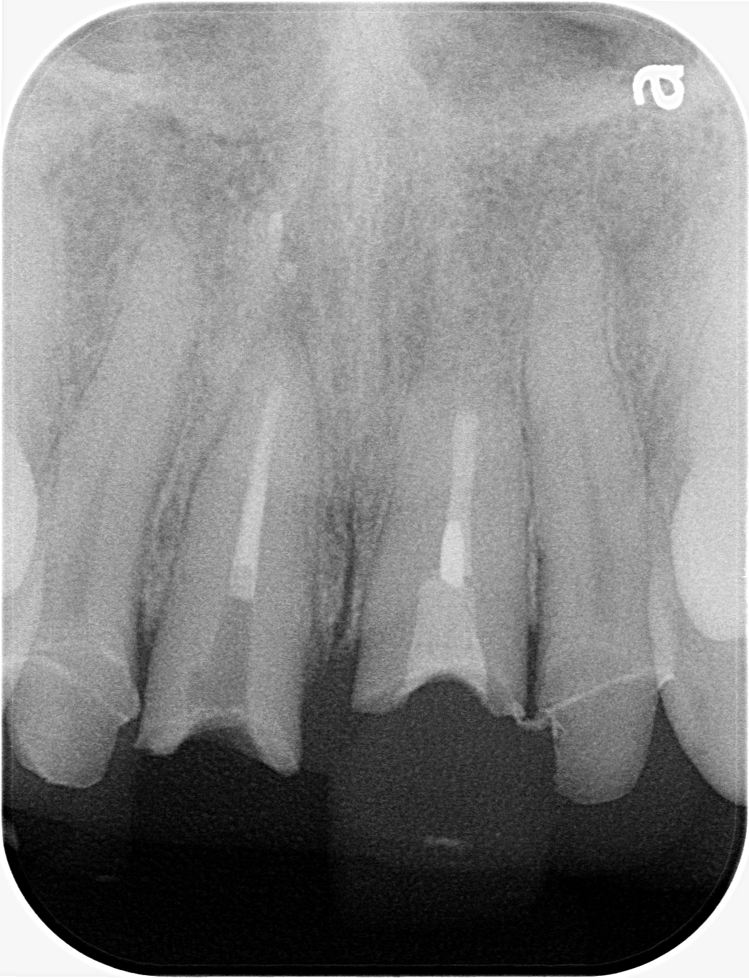 手術回数１回　身体に負担の少ない前歯のインプラント治療