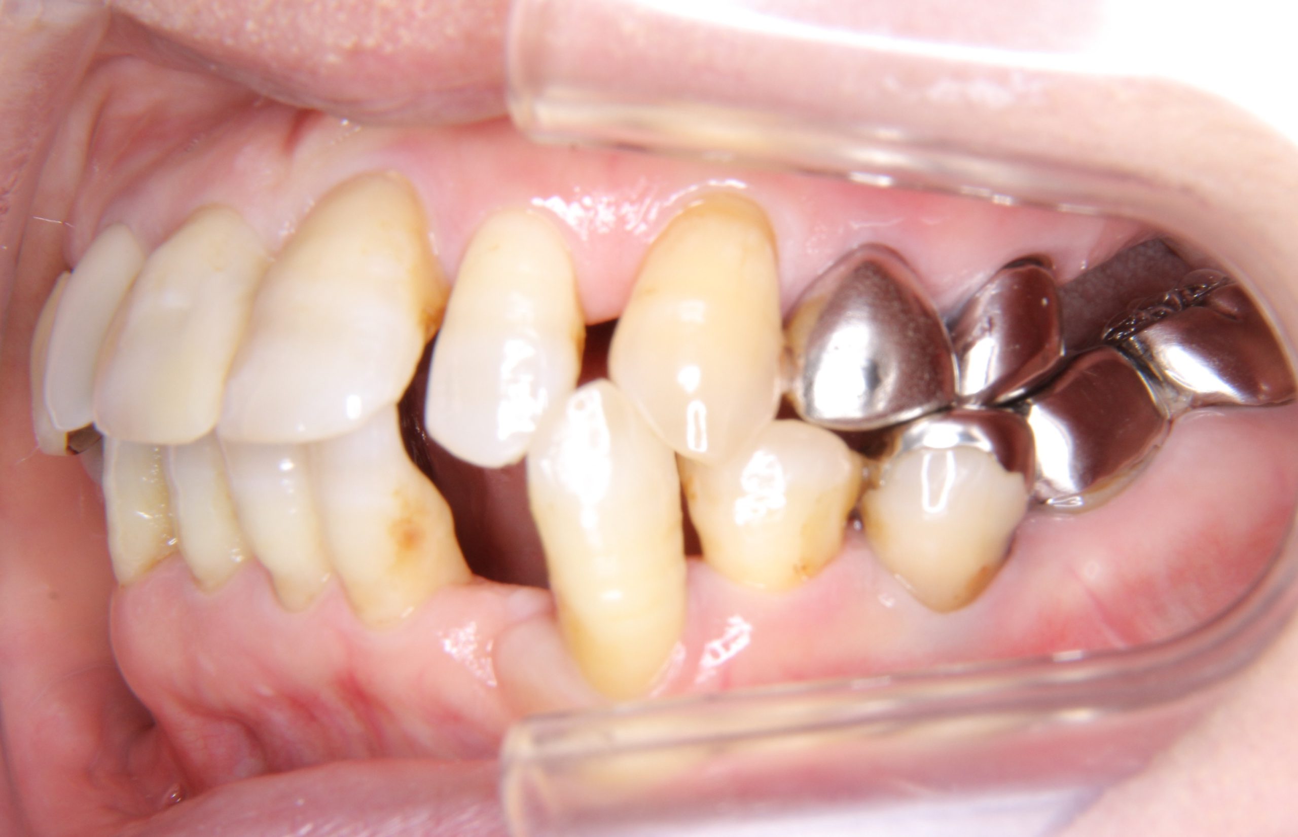 歯並びに問題がある方へのインプラント治療