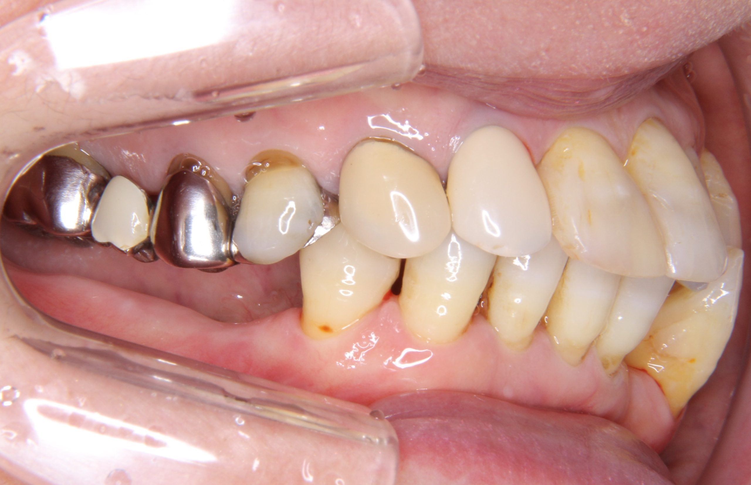 歯並びに問題がある方へのインプラント治療