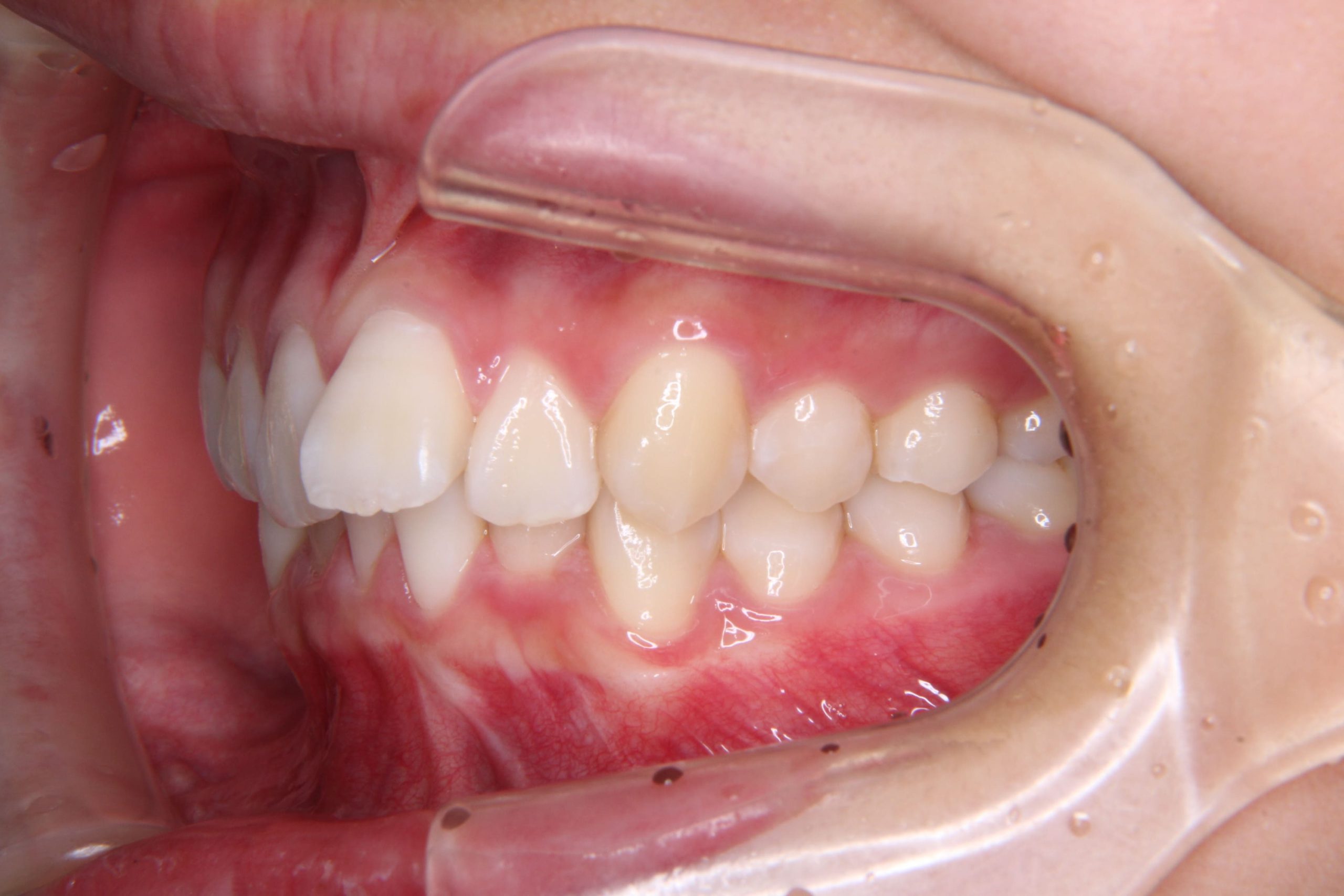 上の歯が出ていてガタガタの歯をインビザライン（マウスピース矯正）で矯正