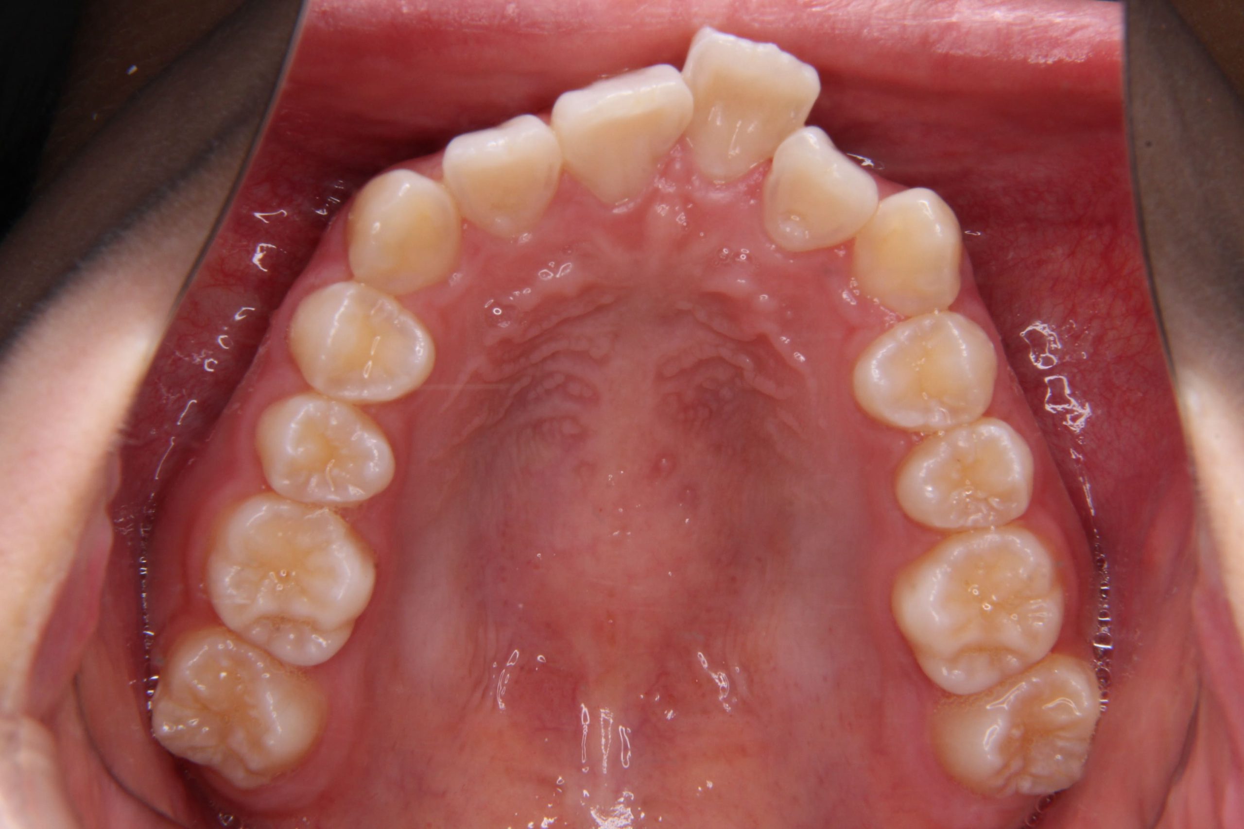 上の歯が出ていてガタガタの歯をインビザライン（マウスピース矯正）で矯正