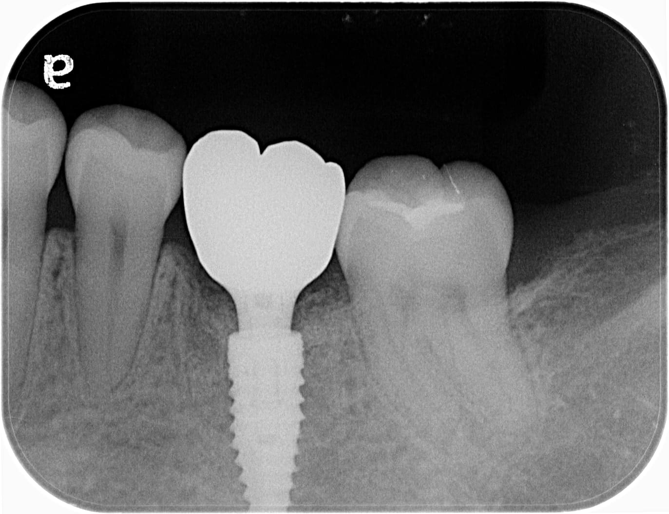 痛み・腫れが少ないインプラント治療（抜歯を含めて手術回数１回）