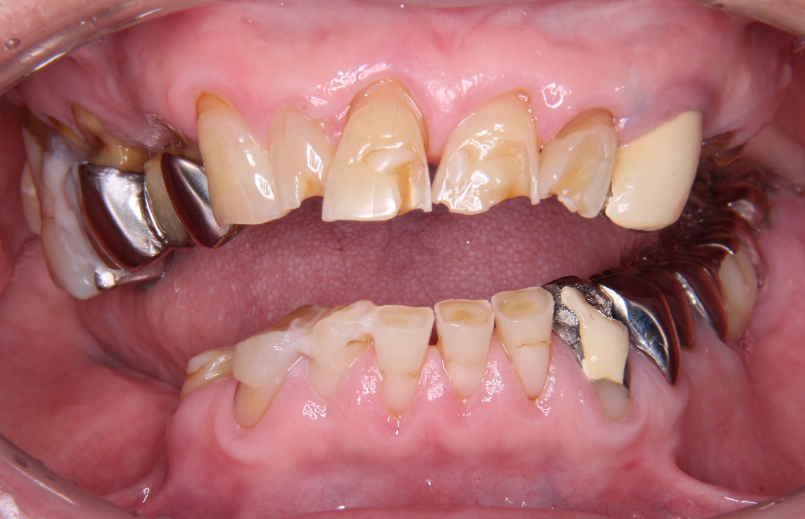 「歯がボロボロ…それは、Tooth Wearかもしれません。原因と治療法を徹底解説！」