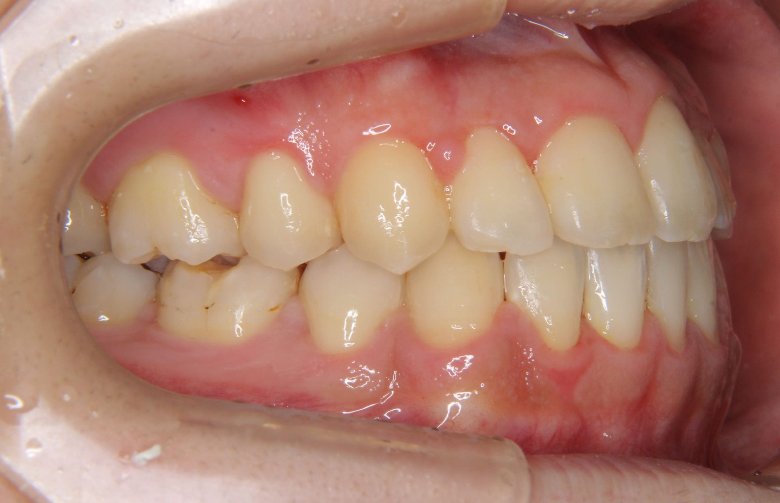 反対咬合（受け口・前歯の噛み合わせが反対）の矯正治療