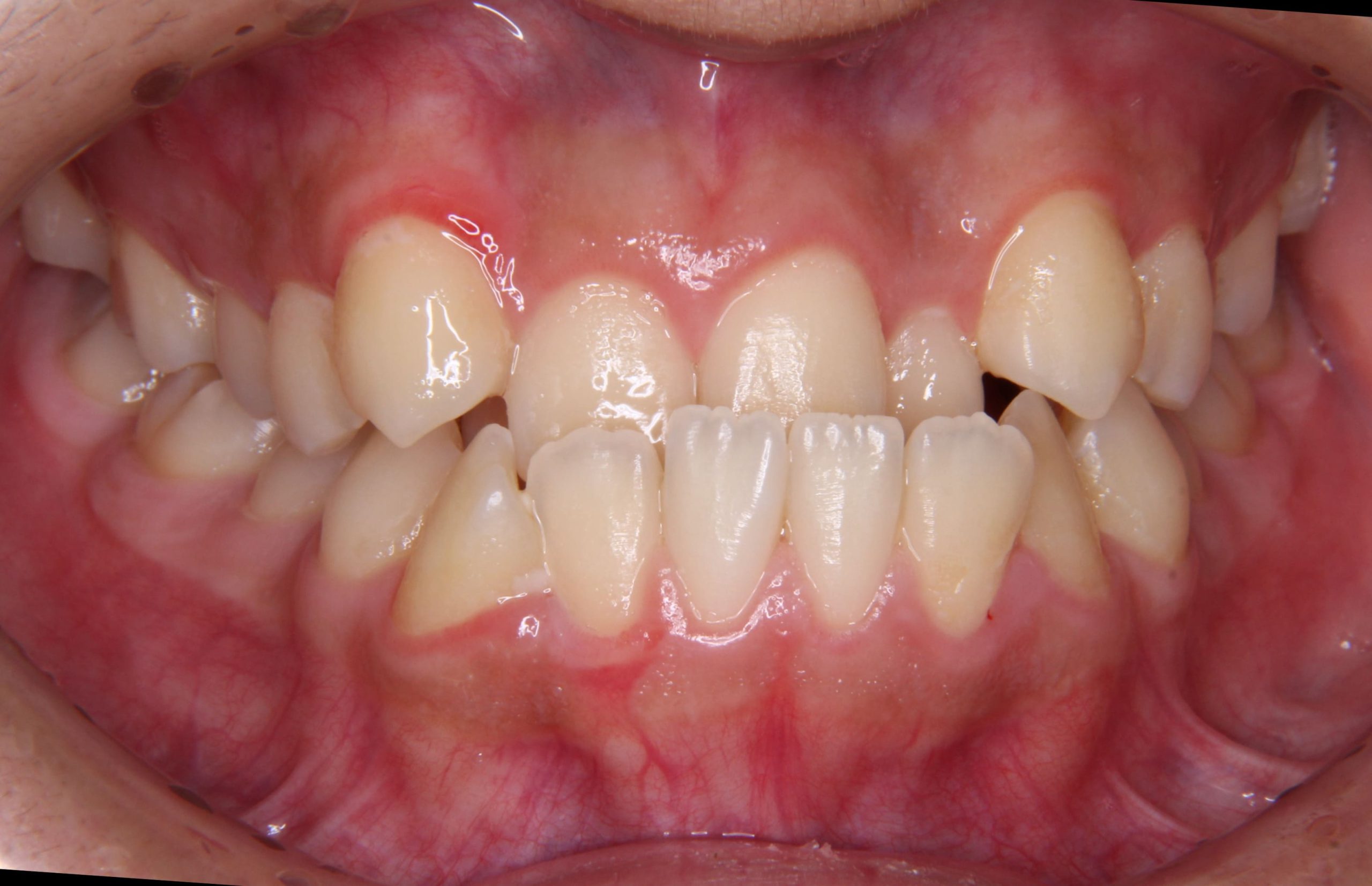 反対咬合（受け口・前歯の噛み合わせが反対）の矯正治療