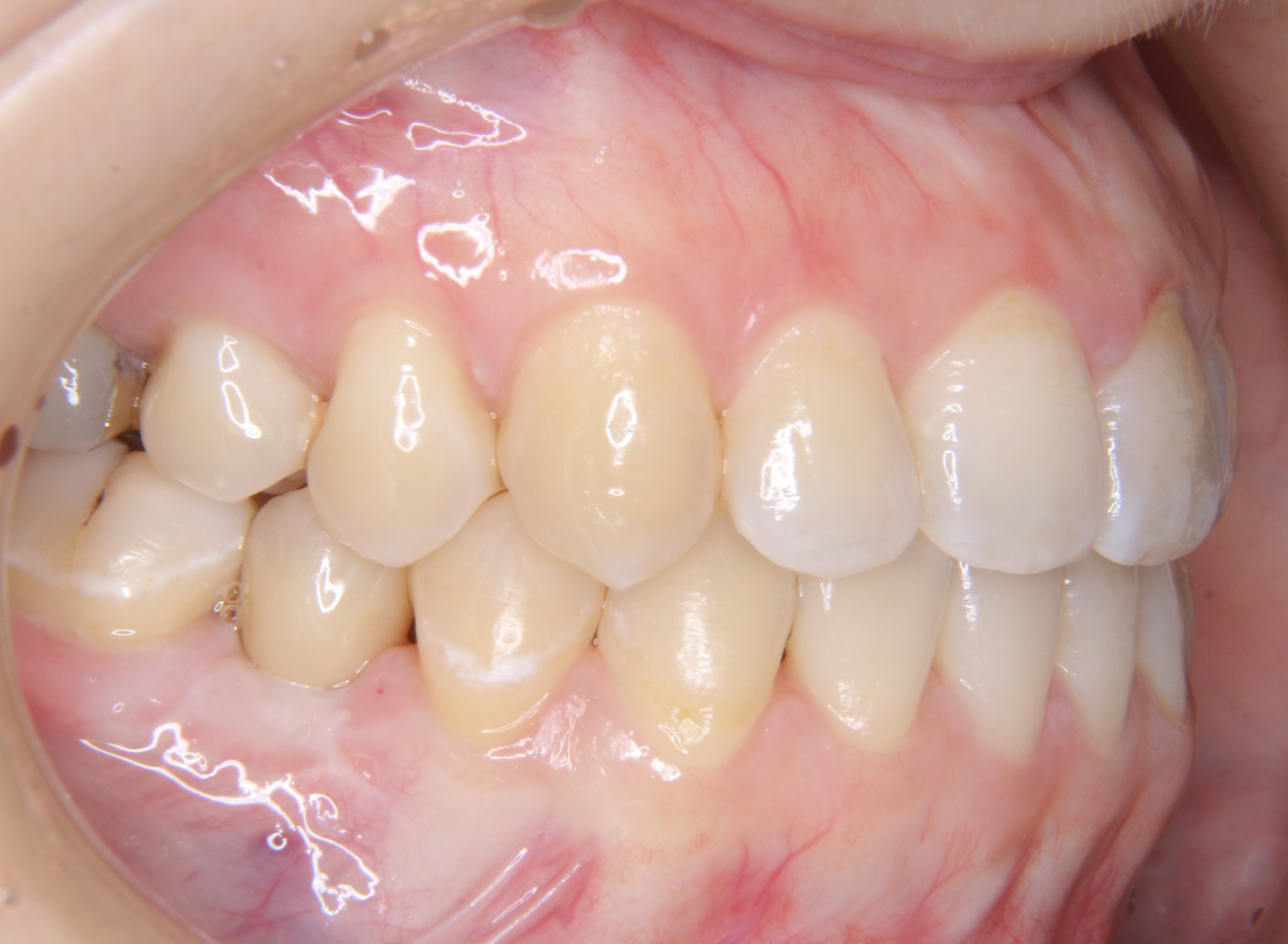反対咬合（受け口）で生まれつき奥歯の永久歯が少ない方に矯正治療とインプラント治療を行なった症例