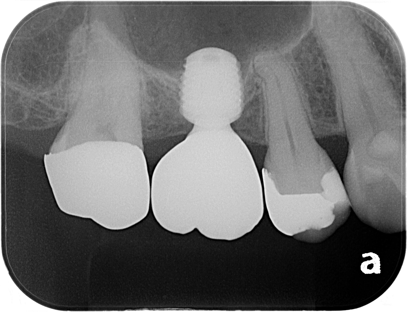 上顎の奥歯の部分に骨が少ないと説明を受けた方へ（ショートインプラントについて）