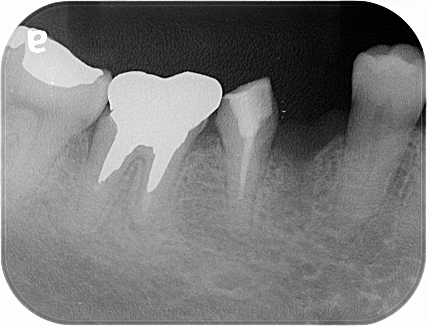下の奥歯が破折し抜歯になった部位にインプラント治療を行なった症例