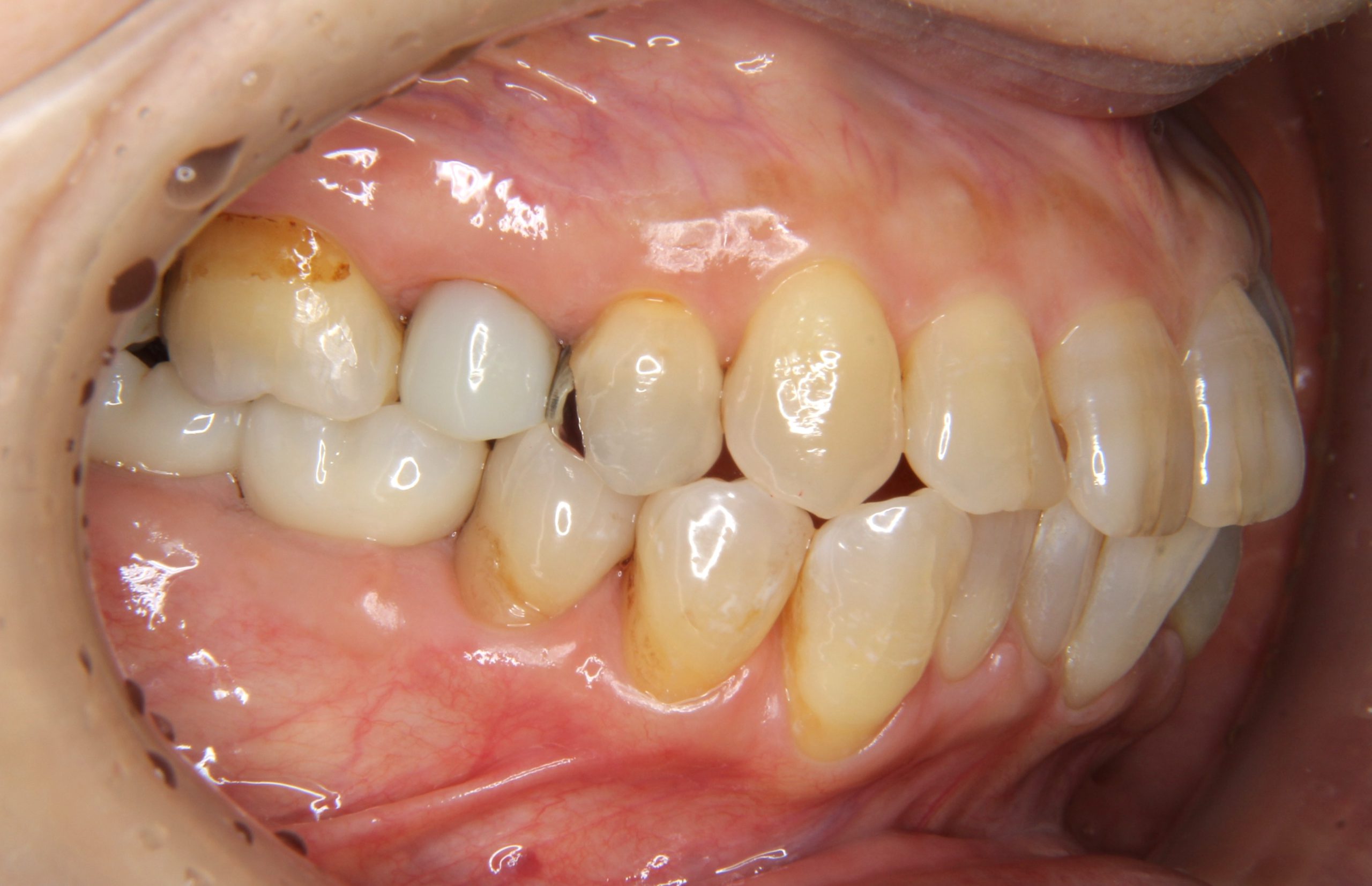 下の奥歯が破折し抜歯になった部位にインプラント治療を行なった症例