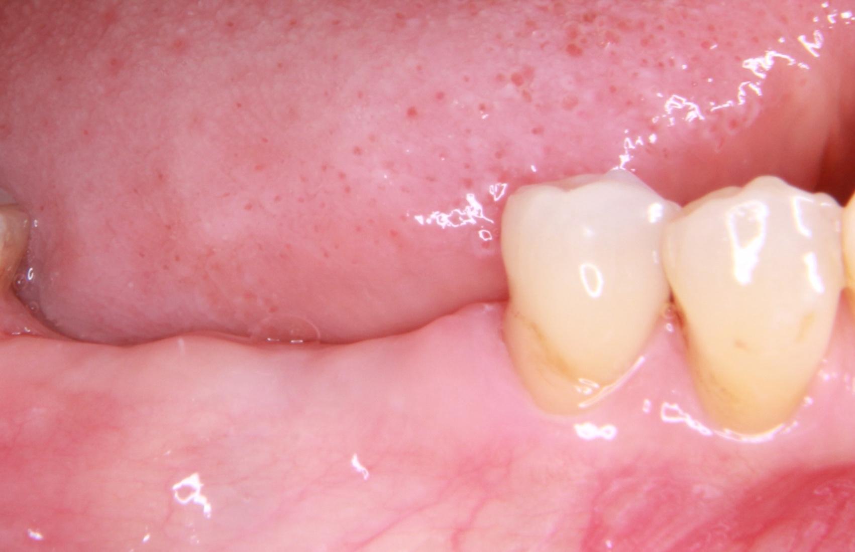 歯が破折し抜歯になった部位にインプラント治療を行なった症例（下の奥歯）