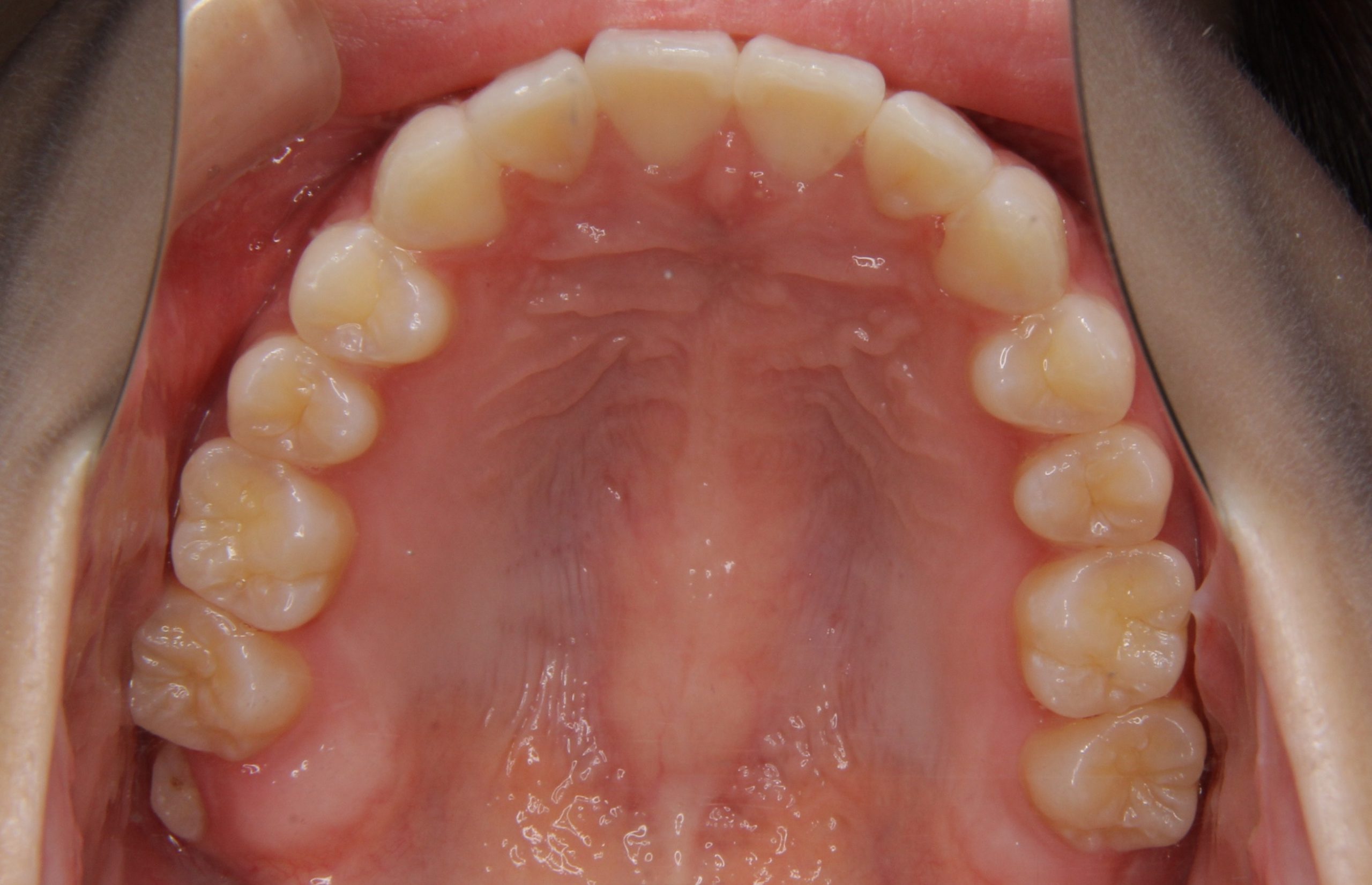 上の歯が出っ張りをインビザライン（マウスピース型矯正治療）で治療