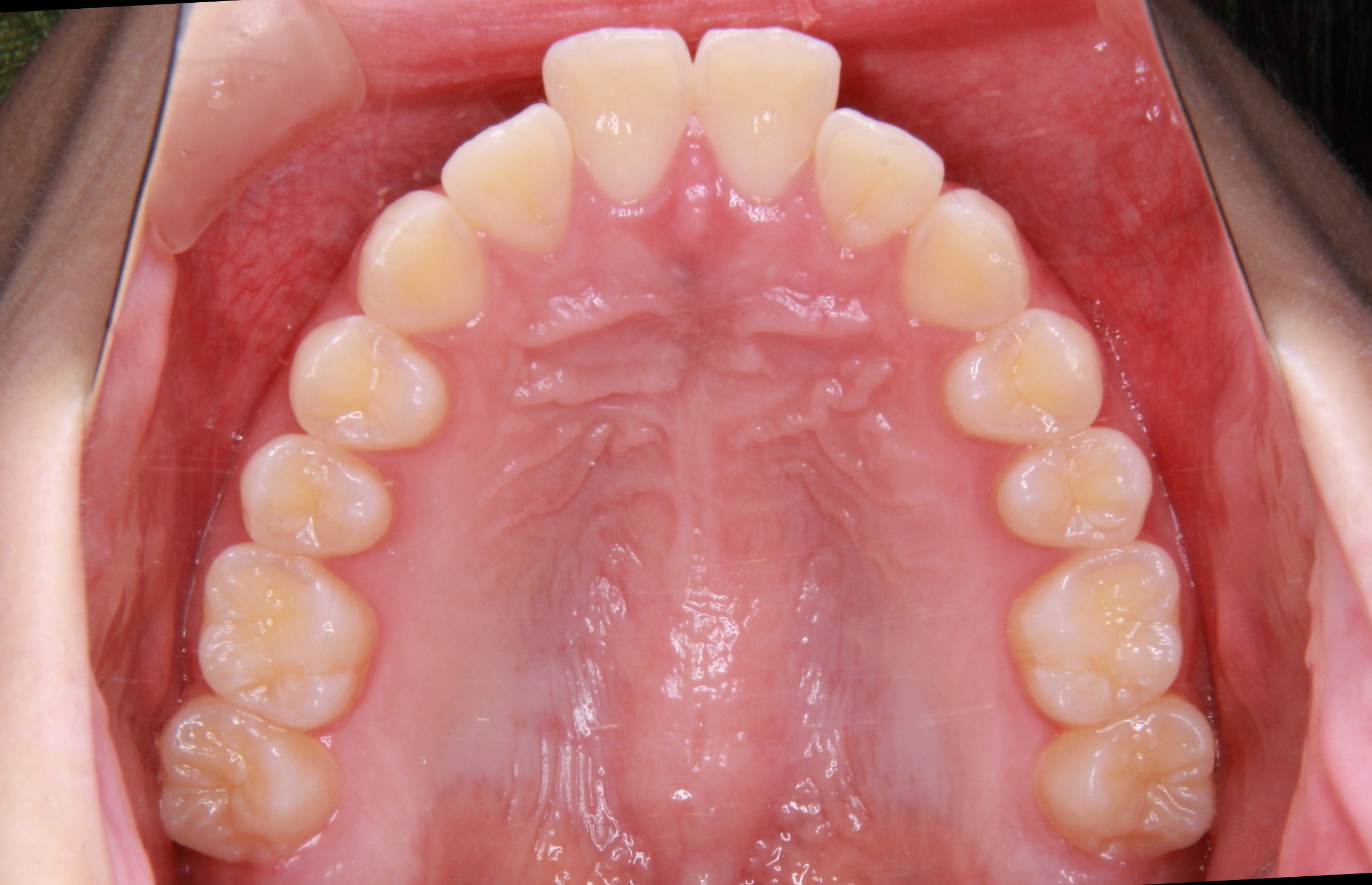 上の前歯が出ているのをインビザライン（マウスピース型矯正治療）で治療