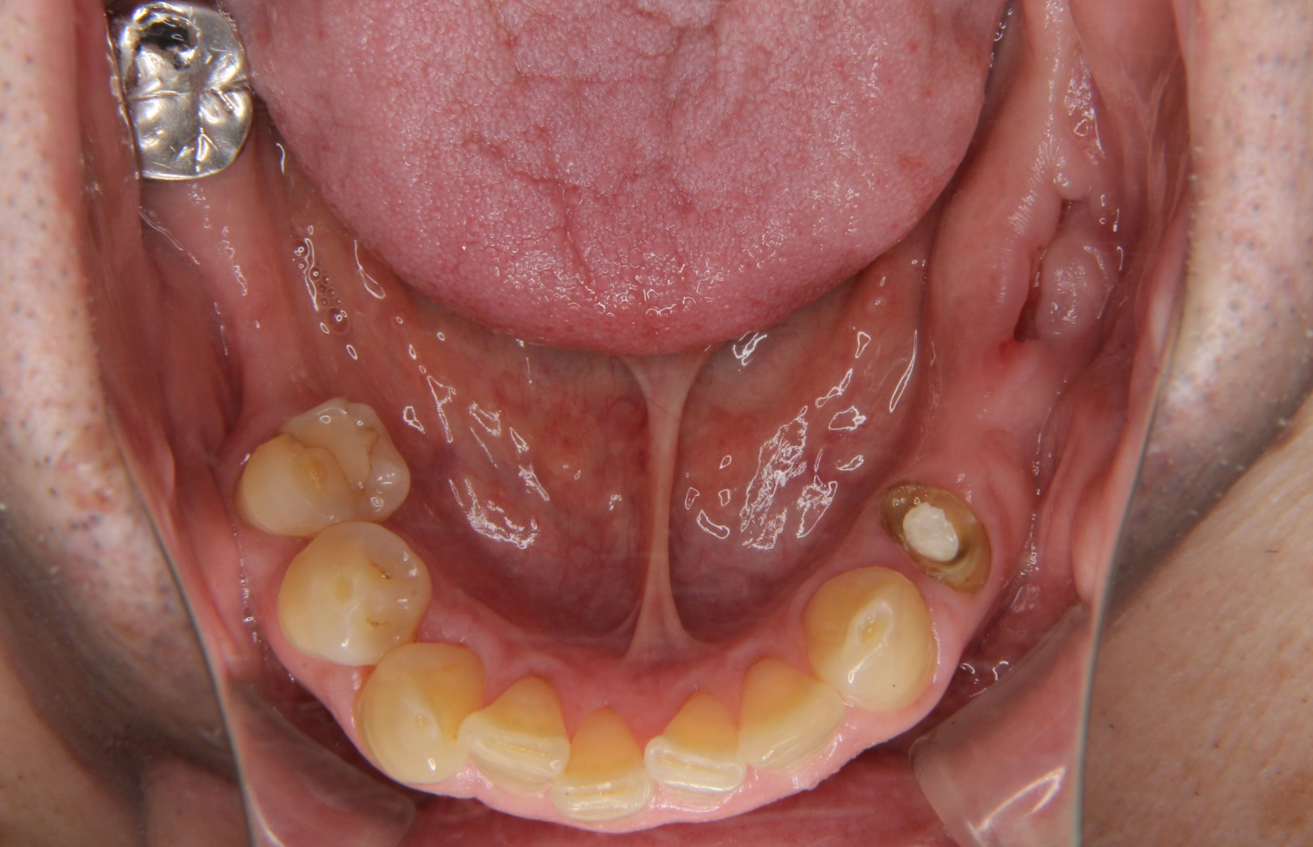 下顎両側の奥歯にインプラントを行なった症例
