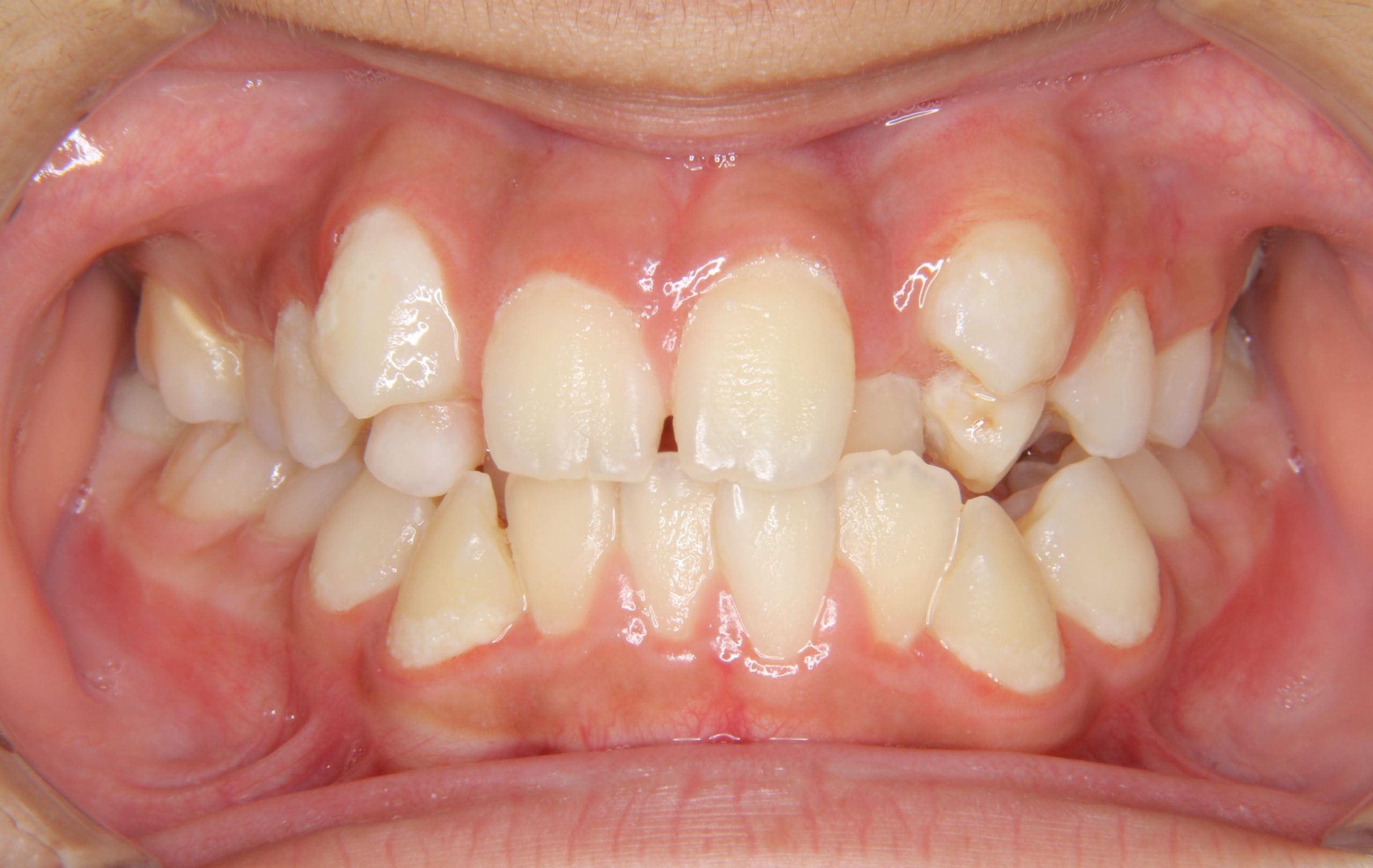 八重歯の矯正治療