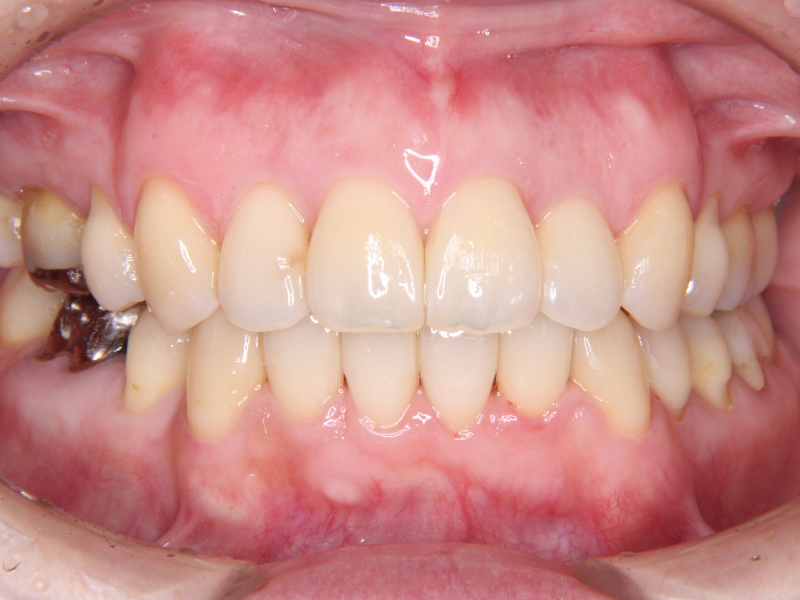 開咬（前歯で噛めない）&叢生（デコボコ、ガタガタ）の歯並びの矯正治療