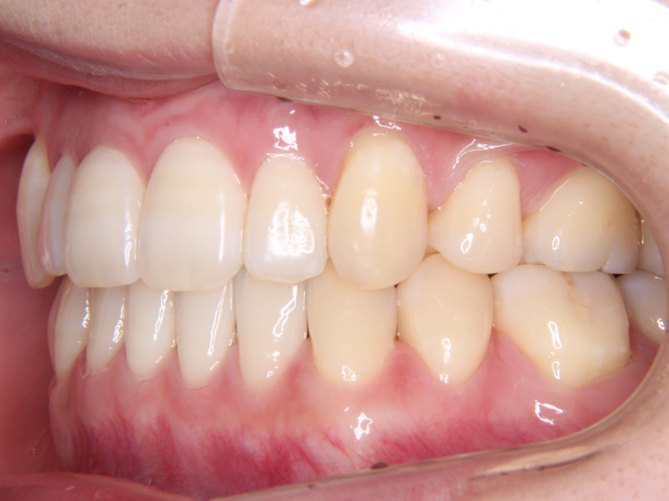 奥歯の反対咬合を見えにくい装置（舌側矯正）で矯正治療した症例