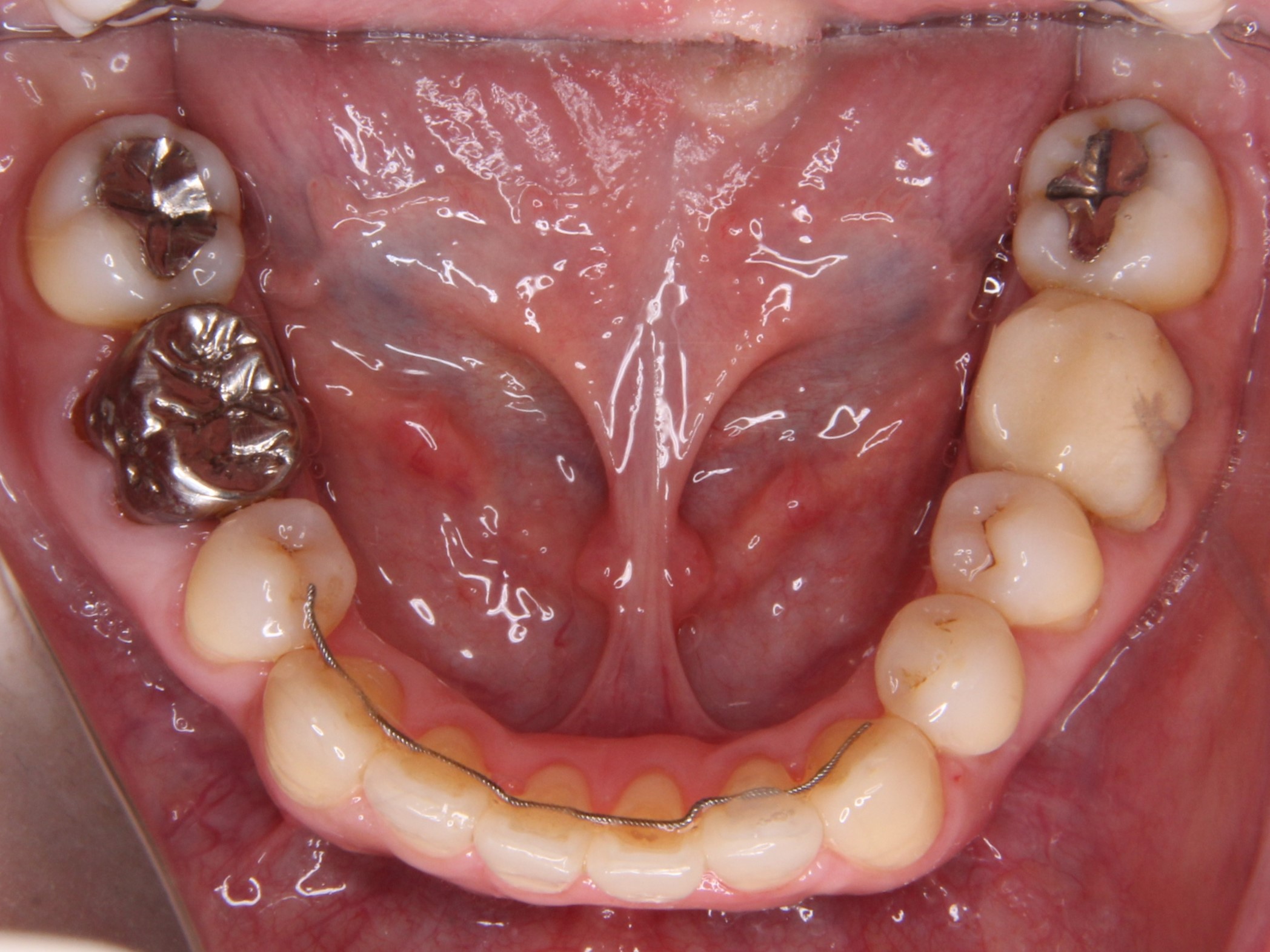 開咬（前歯で噛めない）&叢生（デコボコ、ガタガタ）の歯並びの矯正治療