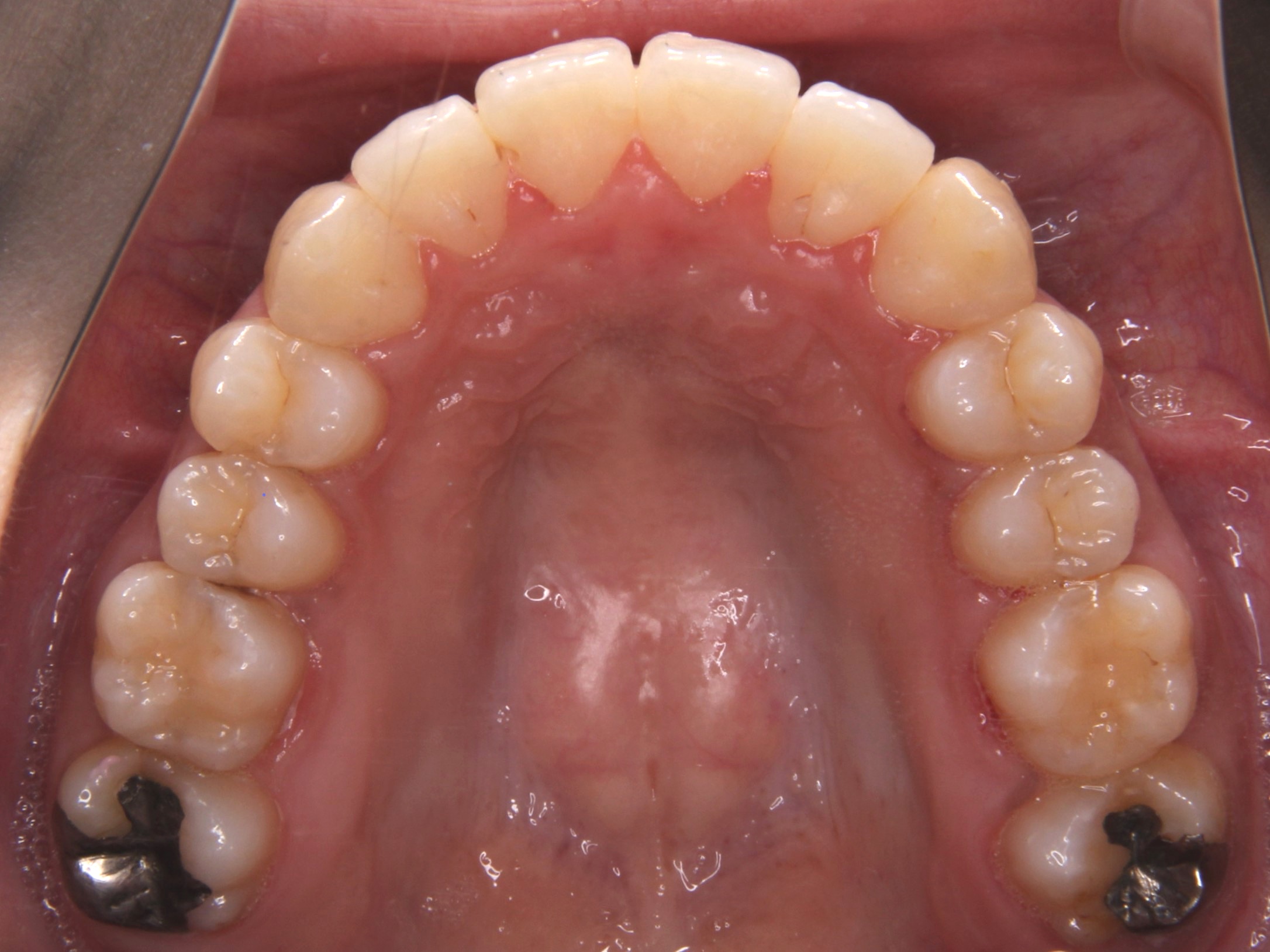 叢生歯列（乱杭歯・デコボコ）を抜歯せずに矯正治療した症例