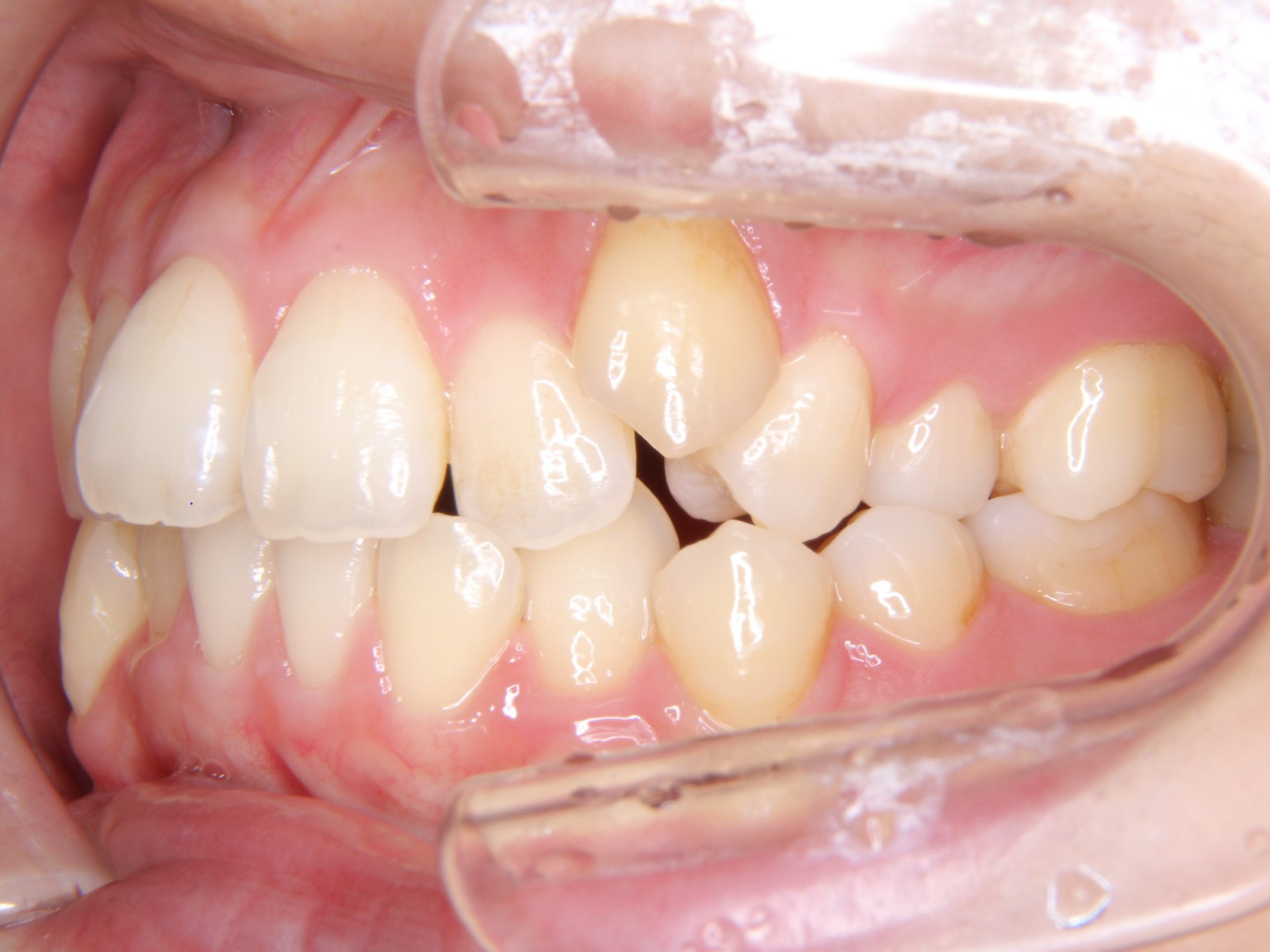 叢生歯列（乱杭歯・デコボコ）を抜歯せずに矯正治療した症例