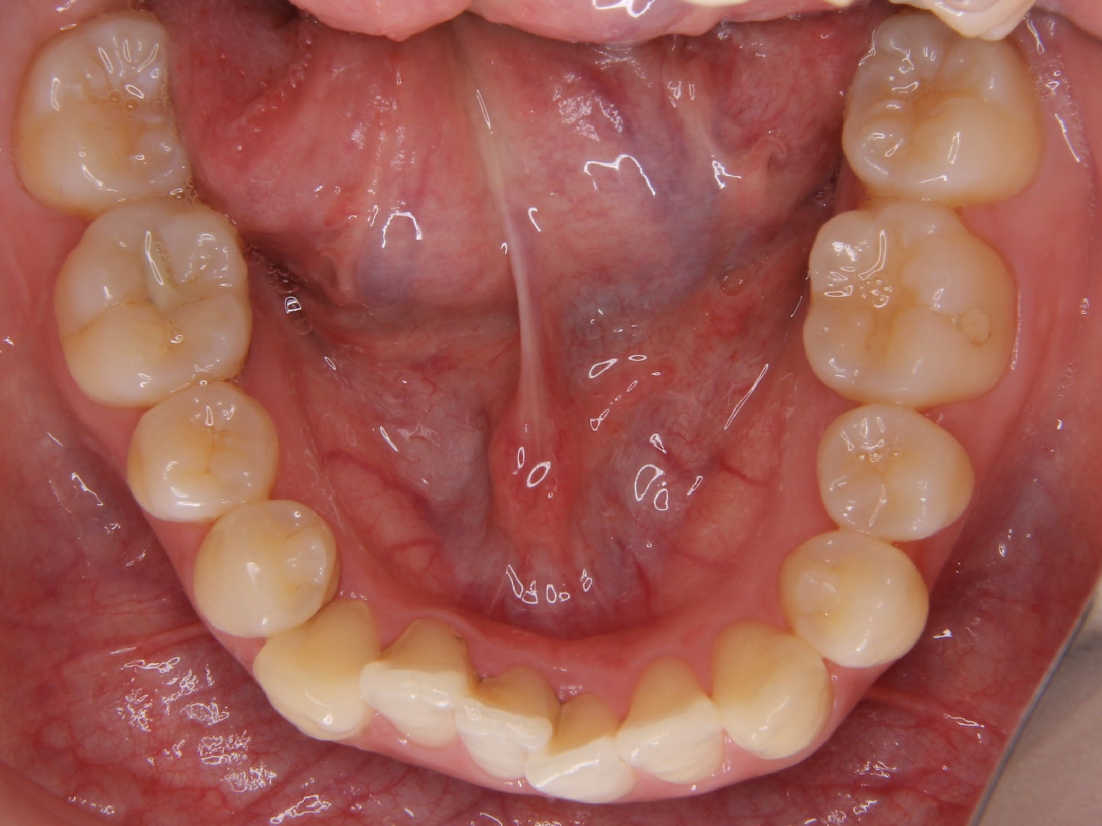 奥歯の反対咬合を見えにくい装置（舌側矯正）で矯正治療した症例