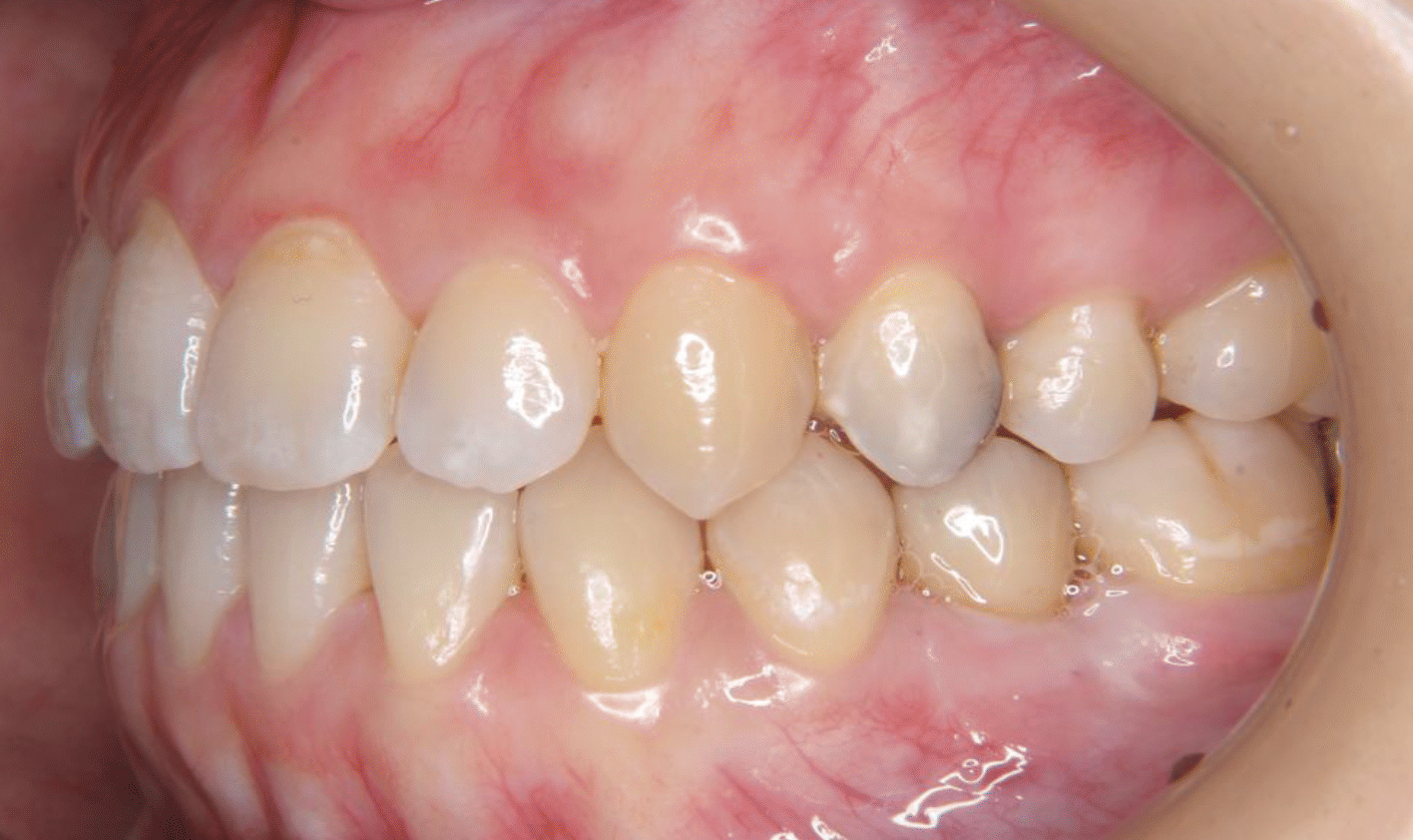 反対咬合（受け口）で生まれつき奥歯の永久歯が少ない方に矯正治療とインプラント治療を行なった症例