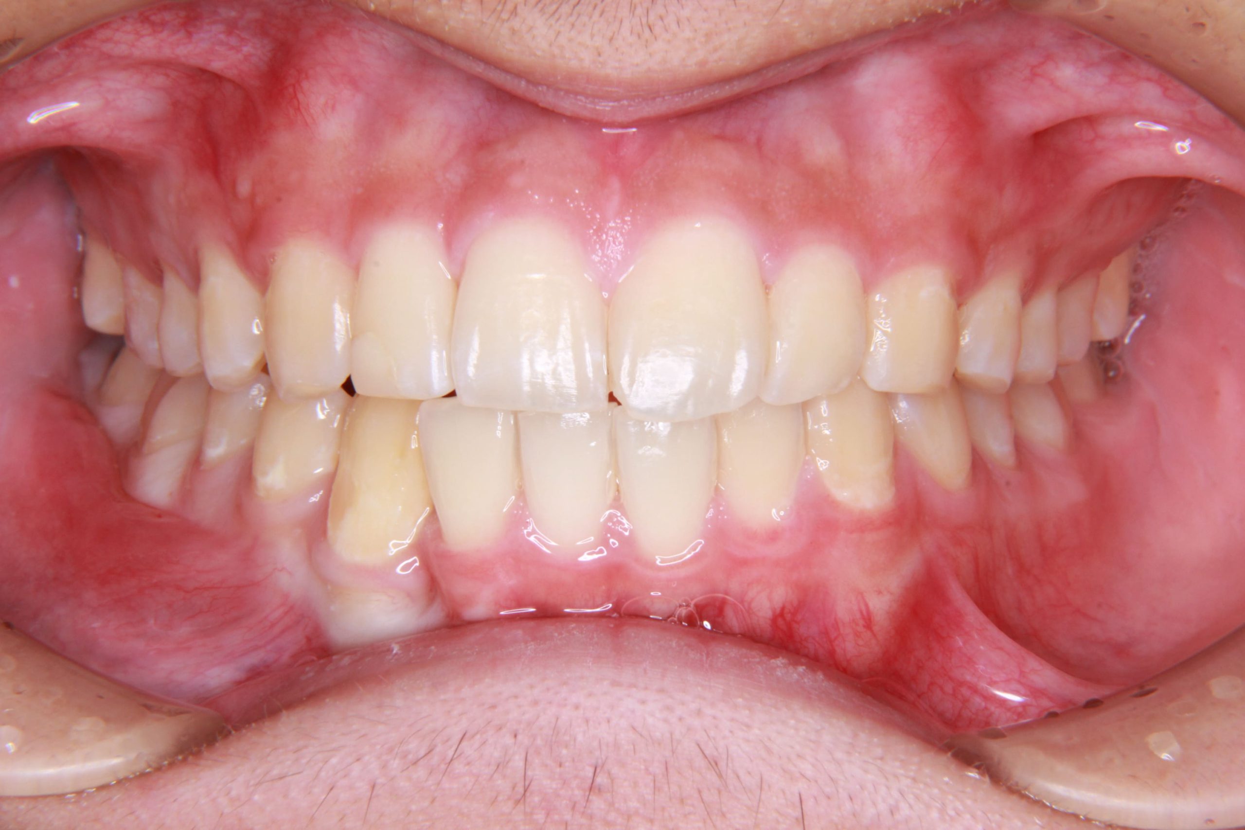生えてこれらない犬歯（埋伏した犬歯）に対して矯正治療した症例