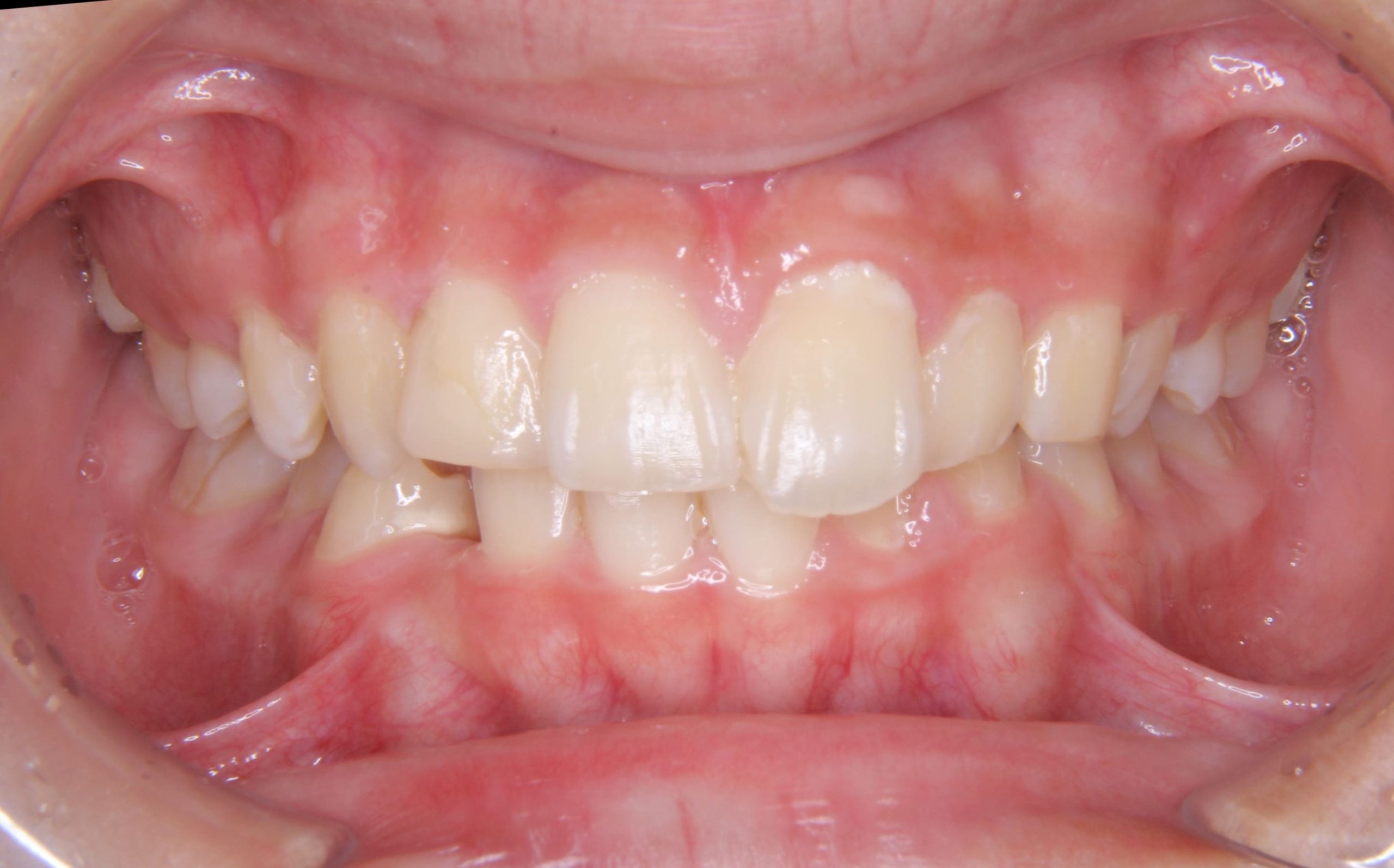 生えてこれらない犬歯（埋伏した犬歯）に対して矯正治療した症例