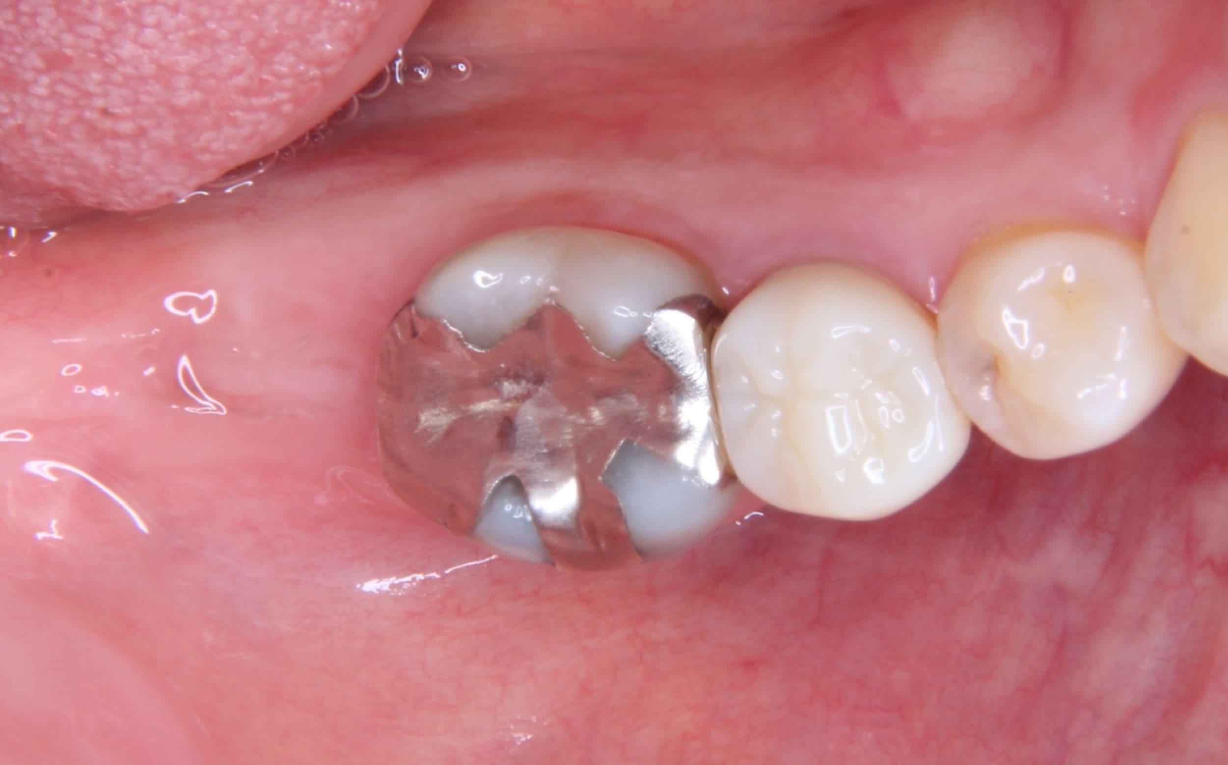 歯根破折により抜歯になった部位へのインプラント治療