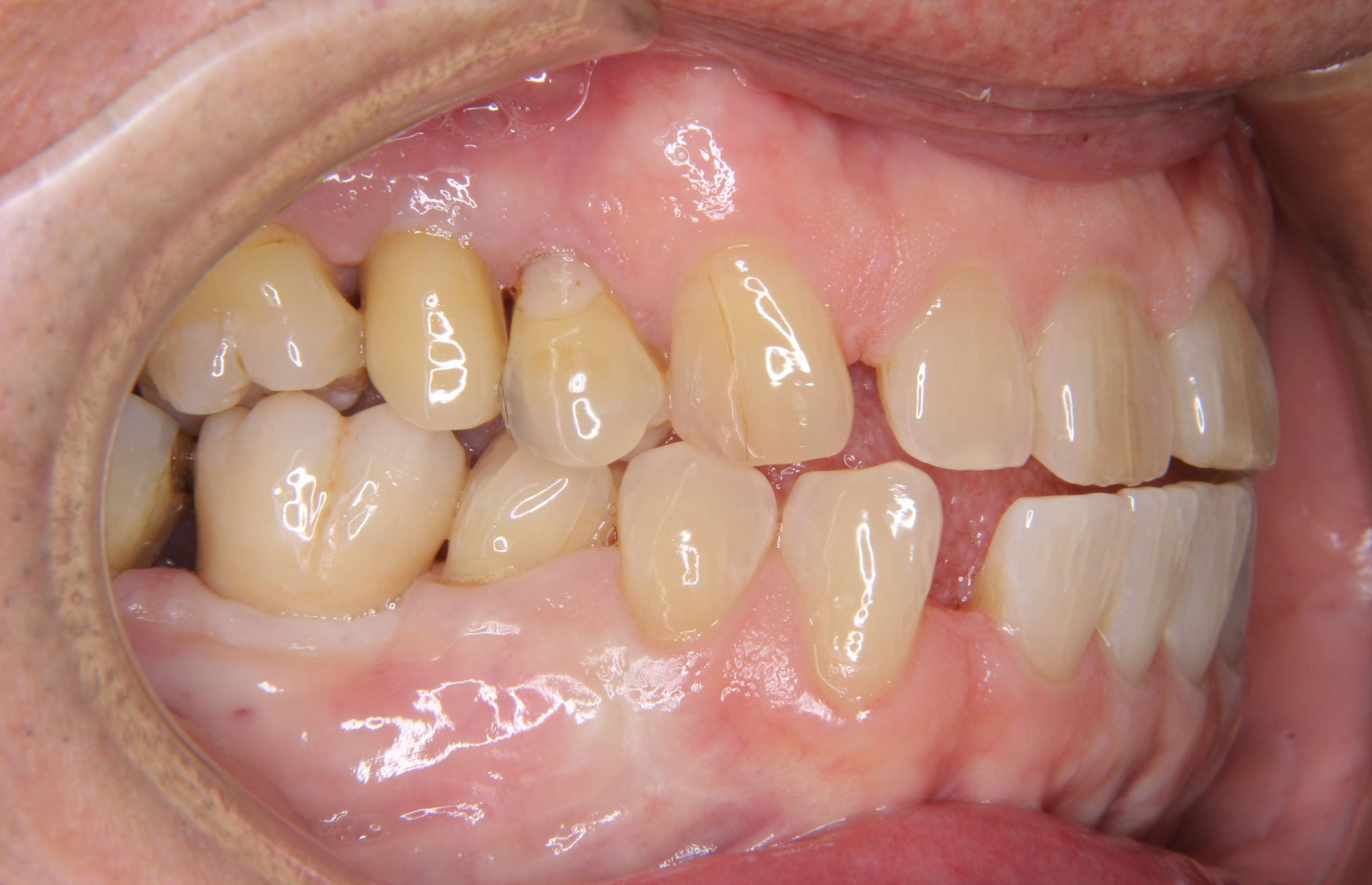 重度歯周炎で抜歯になった部位へのインプラント治療