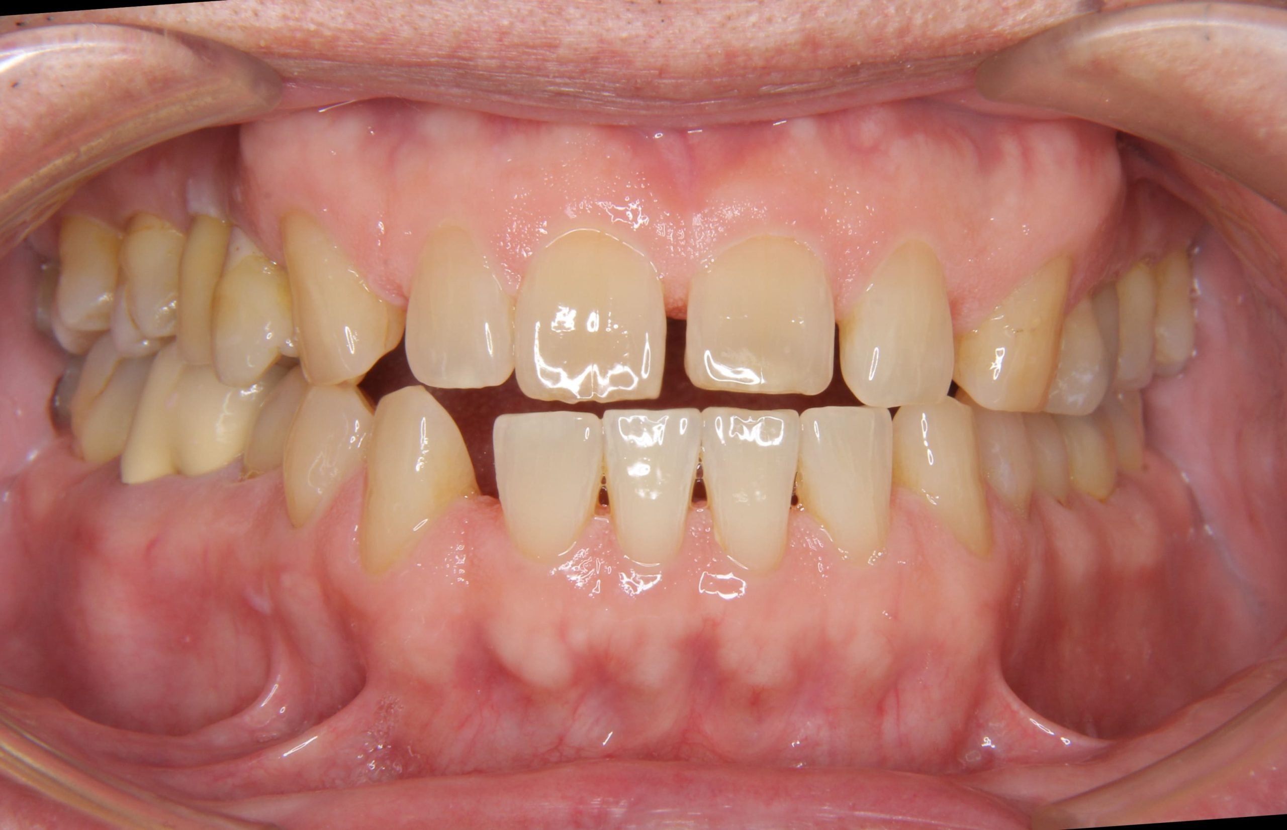 重度歯周炎で抜歯になった部位へのインプラント治療