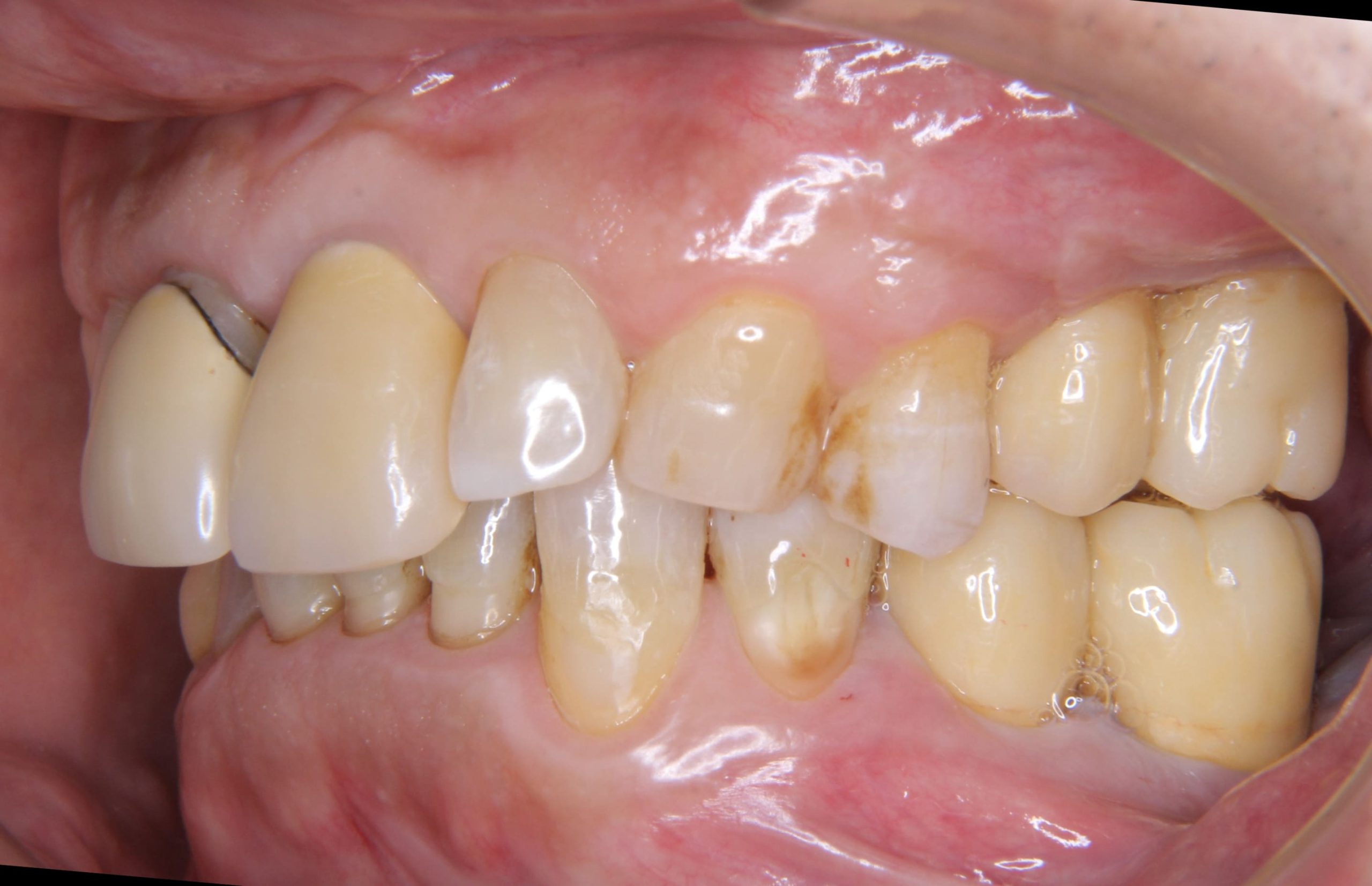 左側上下の奥歯のインプラント治療
