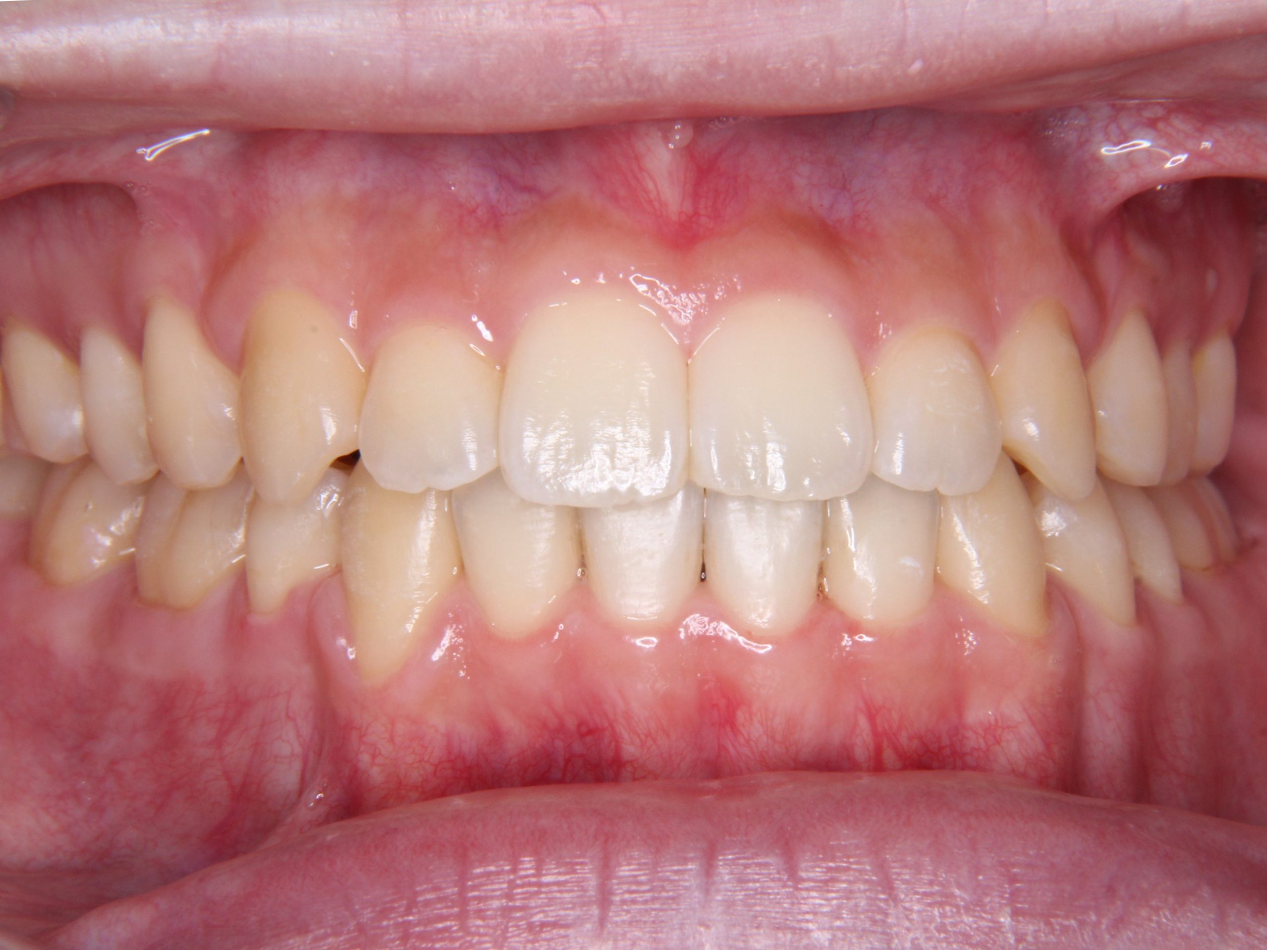 前歯切端咬合、奥歯交叉咬合に対する矯正治療