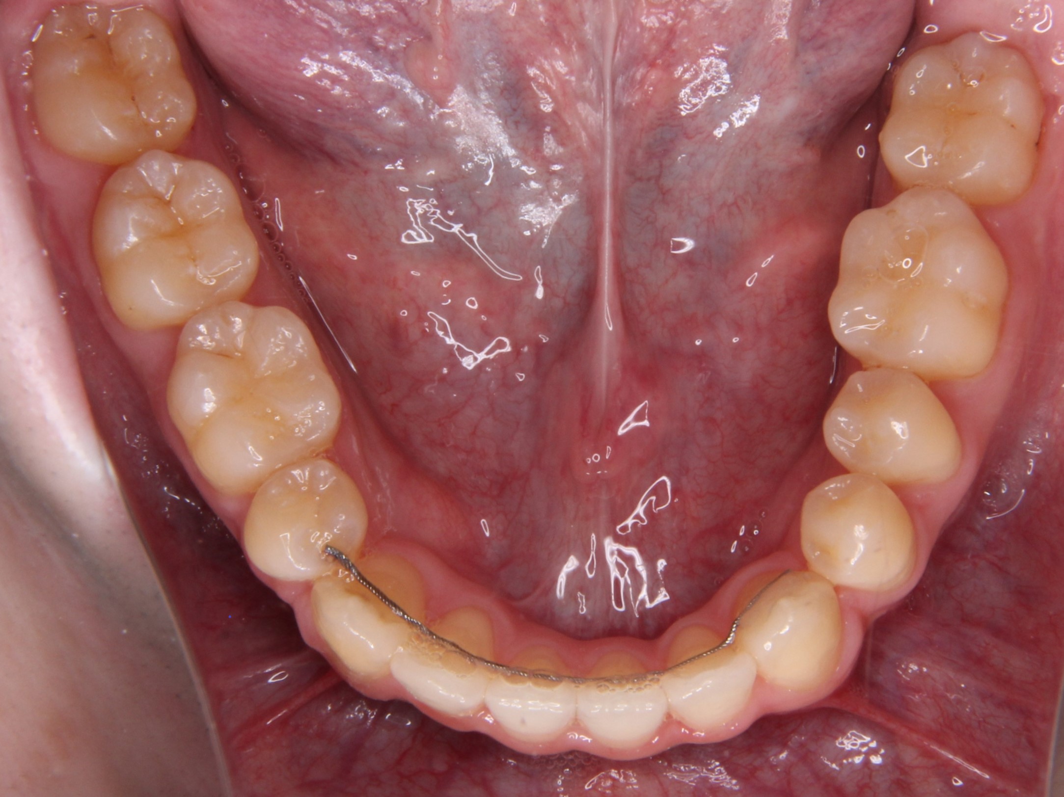 前歯切端咬合、奥歯交叉咬合に対する矯正治療