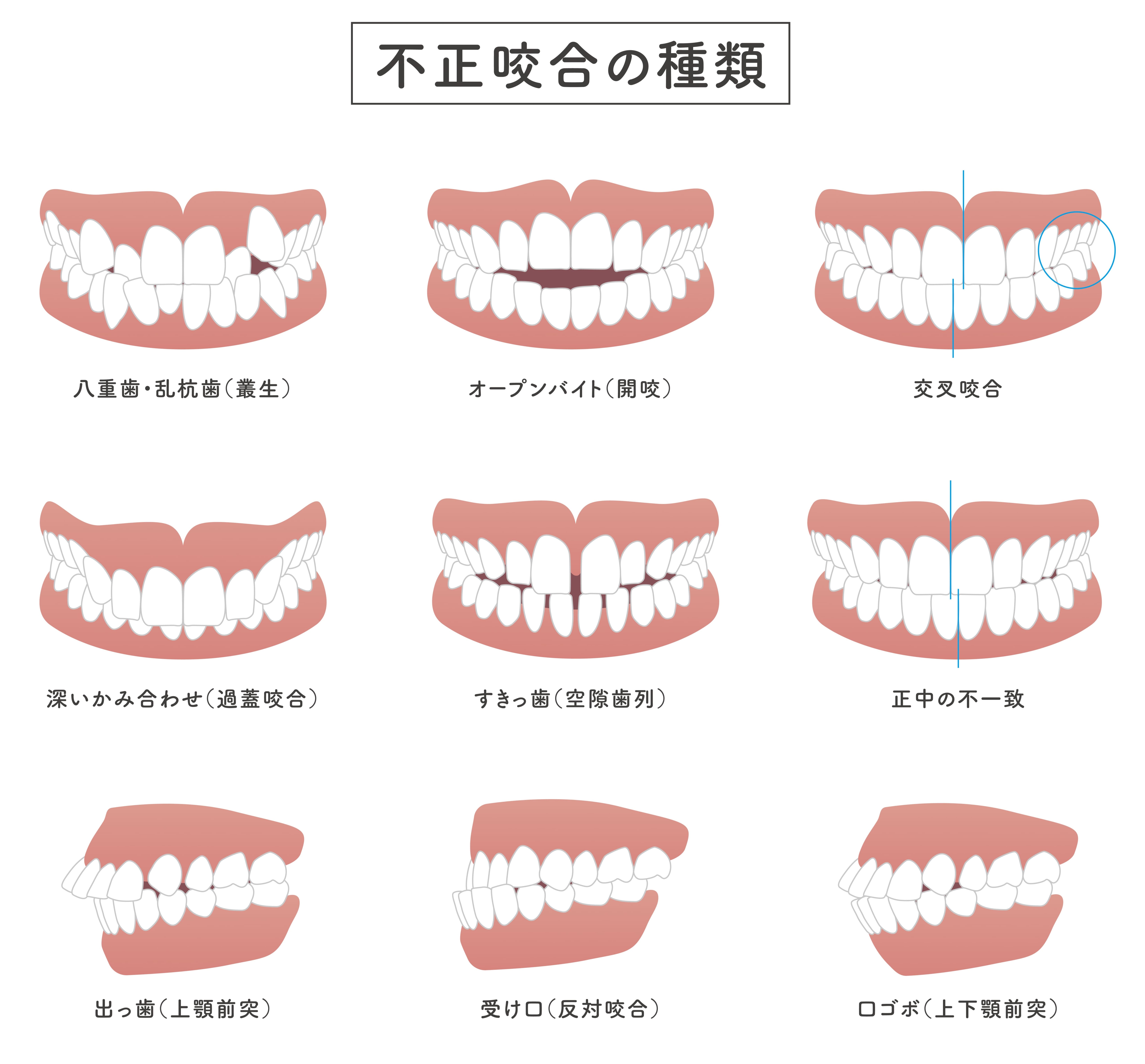 安心・安全の矯正歯科治療③（様々な噛み合わせの不正に対応）